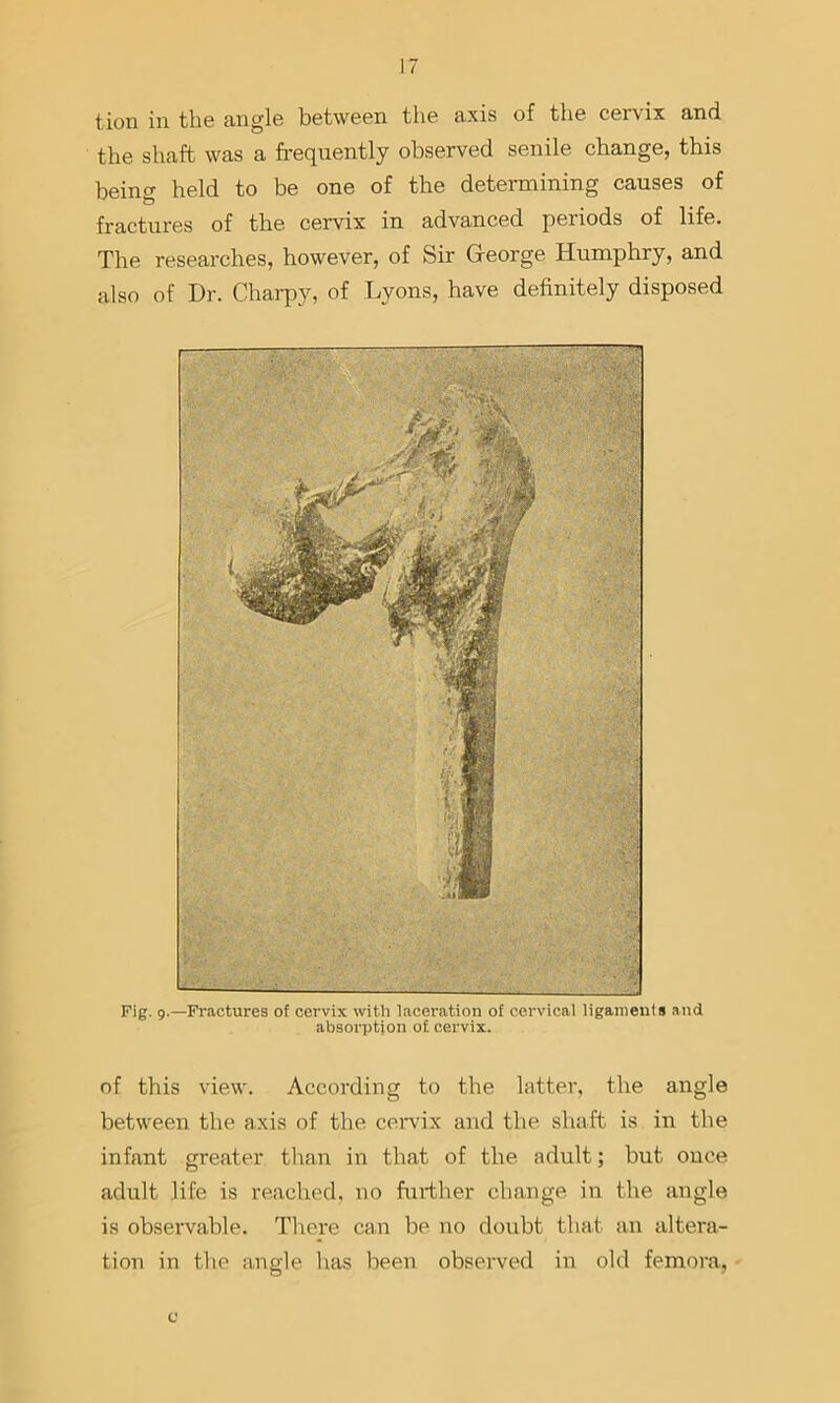 tion in tlie angle between the axis of the cervix and the shaft was a frequently observed senile change, this beino- held to be one of the determining causes of fractures of the cervix in advanced periods of life. The researches, however, of Sir George Humphry, and also of Dr. Charpy, of Lyons, have definitely disposed Fig. 9.—Fractures of cervix wth laceration of cervical ligaments and absorption of cervix. of this view. According to the latter, the angle between the axis of the cervix and the shaft is in the infant greater than in that of the adult; but once adult life is reached, no further change, in the angle is observable. There can be no doubt that an altera- tion in the angle has been observed in old femora.