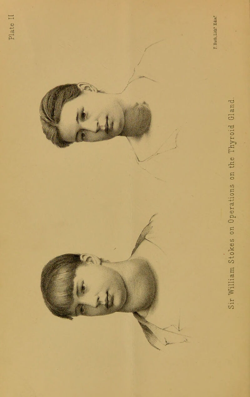 Plate II Sir William Stokes on Operations on the Thyroid Gland.