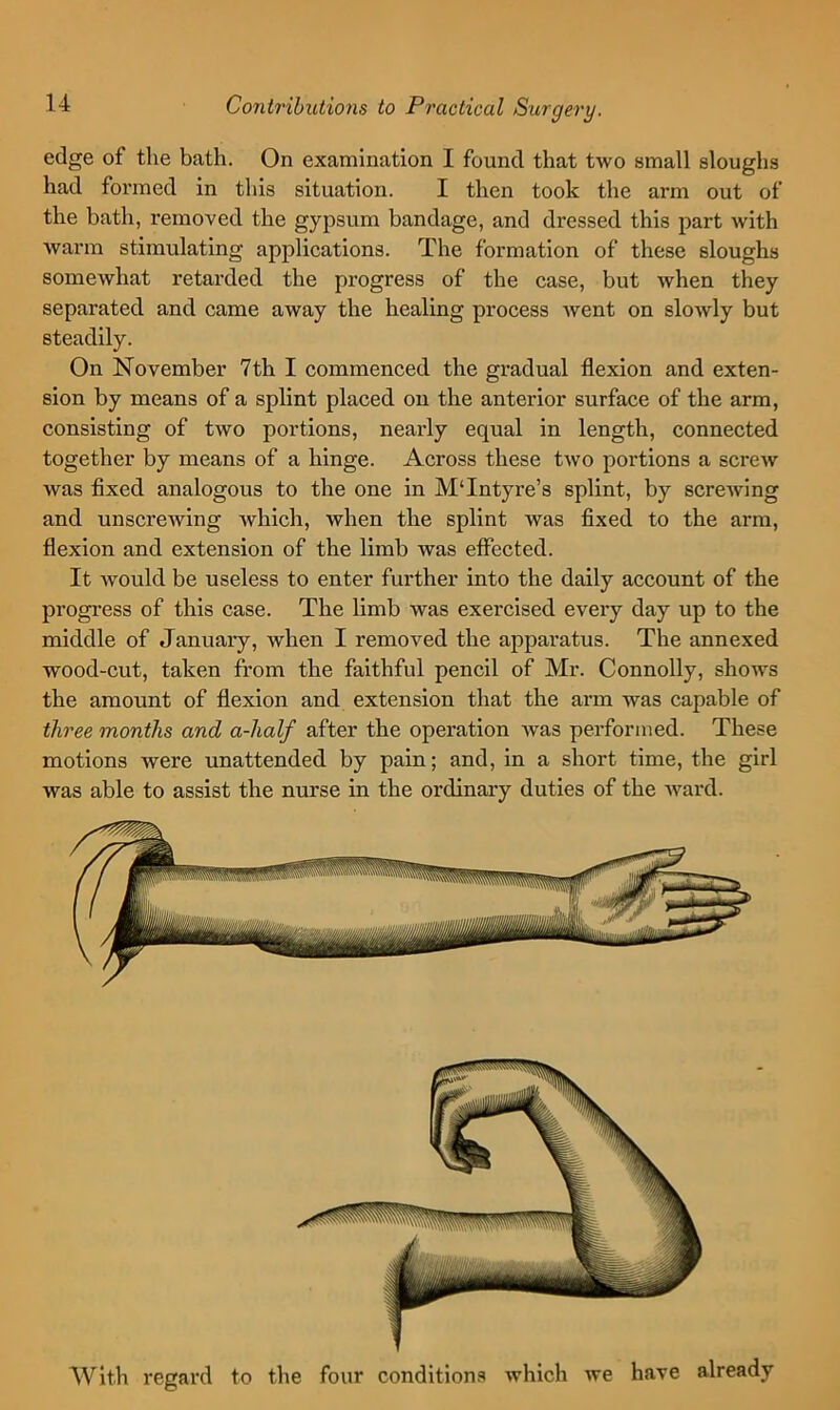 edge of the bath. On examination I found that two small sloughs had formed in this situation. I then took the arm out of the bath, removed the gypsum bandage, and dressed this part with warm stimulating applications. The formation of these sloughs someAvhat retarded the progress of the case, but when they separated and came away the healing process Avent on sloAvly but steadily. On November 7th I commenced the gradual flexion and exten- sion by means of a splint placed on the anterior surface of the arm, consisting of two portions, nearly equal in length, connected together by means of a hinge. Across these two portions a screw was fixed analogous to the one in M‘Intyre’s splint, by scrcAving and unscrewing which, when the splint was fixed to the arm, flexion and extension of the limb was effected. It Avould be useless to enter further into the daily account of the progress of this case. The limb was exercised every day up to the middle of January, when I removed the apparatus. The annexed wood-cut, taken from the faithful pencil of Mr. Connolly, shows the amount of flexion and extension that the arm was capable of three months and a-half after the operation Avas performed. These motions were unattended by pain; and, in a short time, the girl was able to assist the nurse in the ordinary duties of the Avard. With regard to the four conditions which we have already