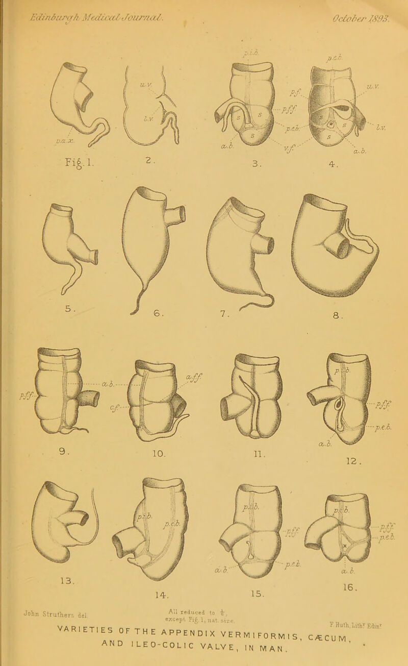 Edinburgh Medical Journal. c October ISOS. John Struthers del All reduced to 'A', except Fig.l, uat. oise. varieties of the appendix vermiformis and ileo-colic VALVE, in man. >’ Hulh.uthT Edinr C/ECUM,