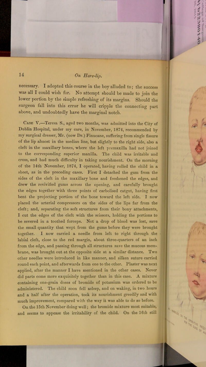 14 necessary. I adopted this course in the boy alluded to; the success was all I could wish for. No attempt should be made to join the lower portion by the simple refreshing of its margins. Should the surgeon fall into this error he will cripple the connecting part above, and undoubtedly have the marginal notch. Case V.—Teresa S., aged two months, was admitted into the City of Dublin Hospital, under my care, in November, 1874, recommended by my surgical dresser, Mr. (now Dr.) Finucane, suffering from single fissure of the lip almost in the median line, but slightly to the right side, also a cleft in the maxillary bones, where the left premaxilla had not joined to the corresponding superior maxilla. The child was irritable and cross, and had much difficulty in taking nourishment. On the morning of the 14th November, 1874, I operated, having rolled the child in a sheet, as in the preceding cases. First I detached the gum from the sides of the cleft in the maxillary bone and freshened the edges, and drew the revivified gums across the opening, and carefully brought the edges together with three points of carbolised catgut, having first bent the projecting portion of the bone toward the left side. I now placed the arterial compressors on the sides of the lips far from the cleft; and, separating the soft structures from their bony attachments, I cut the edges of the cleft with the scissors, holding the portions to be severed in a toothed forceps. Not a drop of blood was lost, save the small quantity that wept from the gums before they were brought together. I now carried a needle from left to right through the labial cleft, close to the red margin, about three-quarters of an inch from the edge, and passing through all structures save the mucous mem- brane, was brought out at the opposite side at a similar distance. Two other needles were introduced in like manner, and silken suture carried round each point, and afterwards from one to the other. Plaster was next applied, after the manner I have mentioned in the other cases. Never did parts come more exquisitely together than in this case. A mixture containing one-grain doses of bromide of potassium was ordered to be administered. The child soon fell asleep, and on waking, in two hours and a half after the operation, took its nourishment greedily and with much improvement, compared with the way it was able to do so before. On the 15th November doing well; the bromide mixture most suitable, and seems to appease the irritability of the child. On the 16th still
