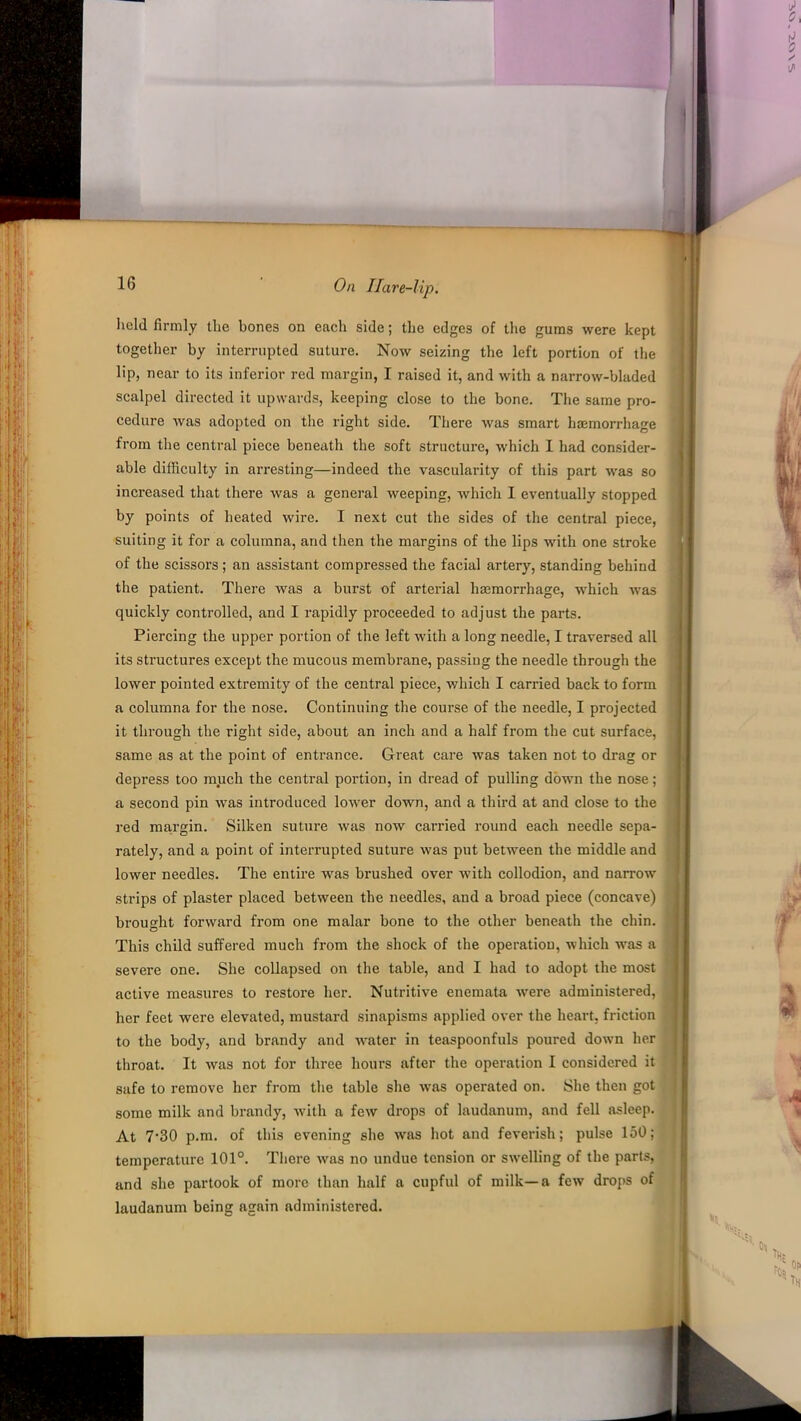 held firmly the bones on each side; the edges of the gums were kept together by interrupted suture. Now seizing the left portion of the lip, near to its inferior red margin, I raised it, and with a narrow-bladed scalpel directed it upwards, keeping close to the bone. The same pro- cedure was adopted on the right side. There -was smart haemorrhage from the central piece beneath the soft structure, which I had consider- able difficulty in arresting—indeed the vascularity of this part was so increased that there was a general weeping, which I eventually stopped by points of heated wire. I next cut the sides of the central piece, suiting it for a columna, and then the margins of the lips with one stroke of the scissors; an assistant compressed the facial artery, standing behind the patient. There was a burst of arterial haemorrhage, which was quickly controlled, and I rapidly proceeded to adjust the parts. Piercing the upper portion of the left with a long needle, I traversed all its structures except the mucous membrane, passing the needle through the lower pointed extremity of the central piece, which I carried back to form a columna for the nose. Continuing the course of the needle, I projected it through the right side, about an inch and a half from the cut surface, same as at the point of entrance. Great care was taken not to drag or depress too much the central portion, in dread of pulling down the nose; a second pin was introduced lower down, and a third at and close to the red margin. Silken suture was now carried round each needle sepa- rately, and a point of interrupted suture was put between the middle and lower needles. The entire was brushed over with collodion, and narrow strips of plaster placed between the needles, and a broad piece (concave) brought forward from one malar bone to the other beneath the chin. This child suffered much from the shock of the operation, which was a severe one. She collapsed on the table, and I had to adopt the most active measures to restore her. Nutritive enemata -were administered, her feet were elevated, mustard sinapisms applied over the heart, friction to the body, and brandy and water in teaspoonfuls poured down her throat. It was not for three hours after the operation I considered it safe to remove her from the table she was operated on. She then got some milk and brandy, with a few drops of laudanum, and fell asleep. At 7'30 p.m. of this evening she was hot and feverish; pulse 150; temperature 101°. There was no undue tension or swelling of the parts, and she partook of more than half a cupful of milk—a few drops of laudanum being again administered.