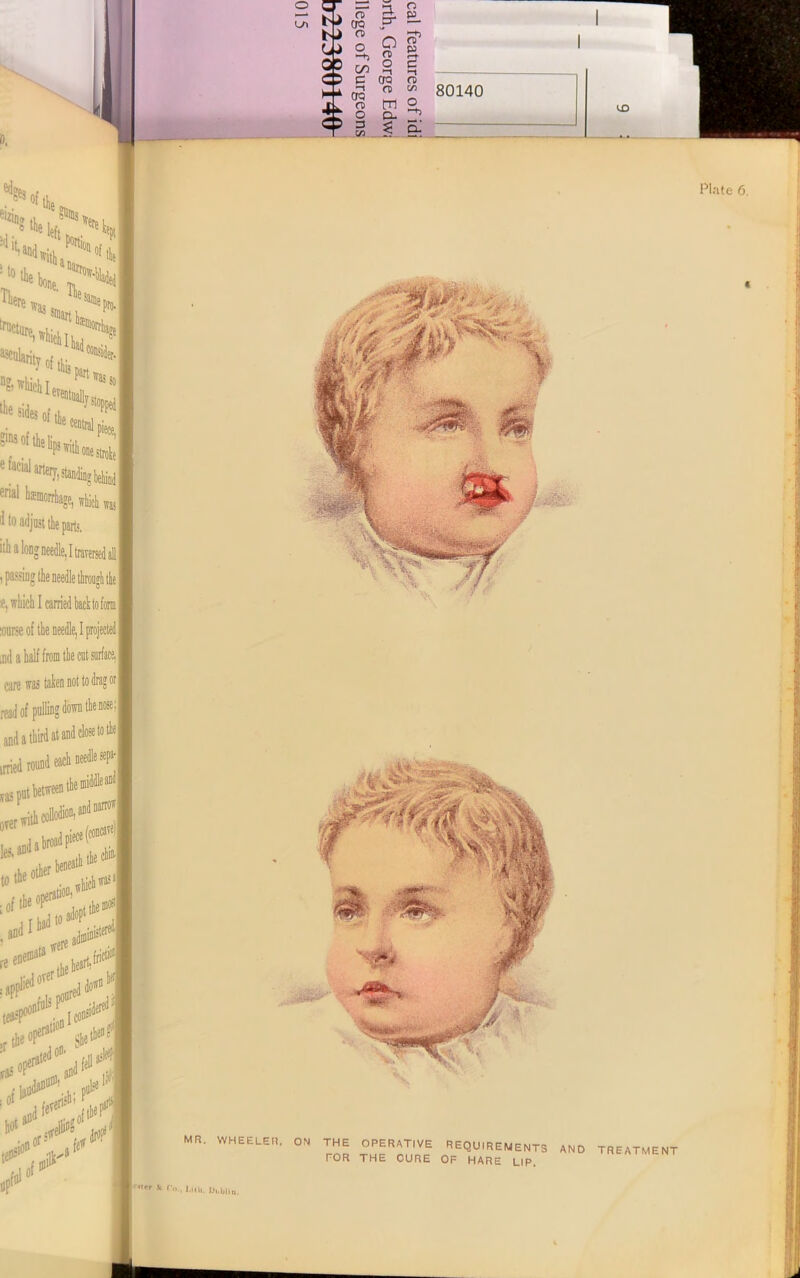 ilh a long needle, I traversed all , passing the needle through the *, which I carried backto fonn :ourse of the needle, I projected md a half from the cut surface. care was taken not to drag or read of palling down the nose;