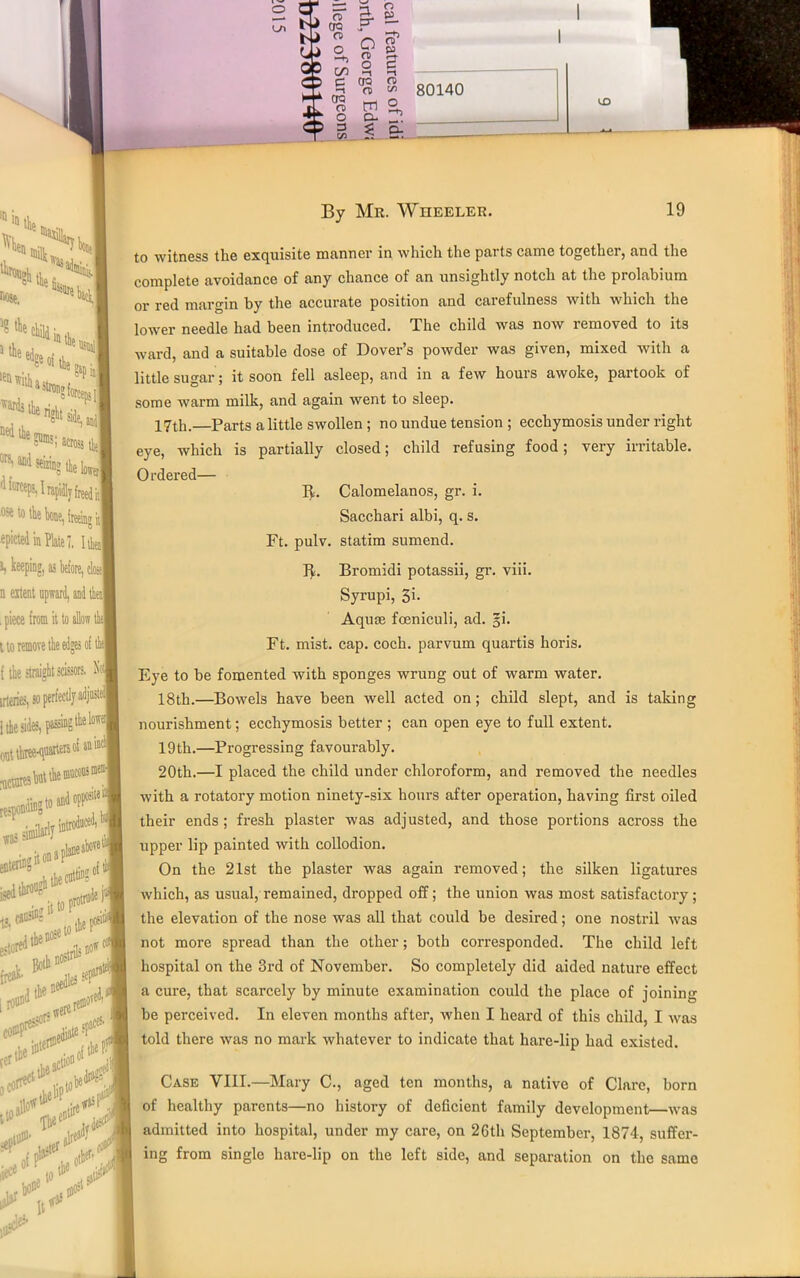 r - — s > CTQ 1 b J <0 , c i 2, < c 3 GO c A era J t a> * o c 5 3 1 C/5 P a p 2 ct «« 80140 s ° 3 & UD 111 'B iL ^gh tv. By Mr. Wheeler. 19 Host, wards ‘te right ii ittting ii| “s; across fe otsi wi seizing the lower' d forceps, I npi, ose to the hoot epicted in Plate 7. id >) keeping, as before, close! n extent . piece from it to allow tiuj t to remove the edge f the straight scissors. Sot irtaies, so 1 the sides, sing the lower] new® rtspondingto ^°i ini was s and opposite ita ts. cans11? it to esto' fre«k- iron111 .DOS' id the' sep! mnved,' toW0. ,1*11 >;y to witness the exquisite manner in which the parts came together, and the complete avoidance of any chance of an unsightly notch at the prolabium or red margin by the accurate position and carefulness with which the lower needle had been introduced. The child was now removed to its ward, and a suitable dose of Dover’s powder was given, mixed with a little sugar; it soon fell asleep, and in a feAV hours awoke, partook of some warm milk, and again went to sleep. 17th.—Parts a little swollen ; no undue tension ; ecchymosis under right eye, which is partially closed; child refusing food; very irritable. Ordered— I£. Calomelanos, gr. i. Sacchari albi, q. s. Ft. pulv. statim sumend. Bromidi potassii, gr. viii. Syrupi, 31- Aquae foeniculi, ad. §i. Ft. mist. cap. coch. parvuni quartis horis. Eye to be fomented with sponges wrung out of warm water. 18th.—BoAvels have been well acted on; child slept, and is taking nourishment; ecchymosis better ; can open eye to full extent. 19th.—Progressing favourably. 20th.—I placed the child under chloroform, and removed the needles with a rotatory motion ninety-six hours after operation, having first oiled their ends ; fresh plaster was adjusted, and those portions across the upper lip painted with collodion. On the 21st the plaster was again removed; the silken ligatures Avhich, as usual, remained, dropped off; the union was most satisfactory ; the elevation of the nose was all that could be desired; one nostril Avas not more spread than the other; both corresponded. The child left hospital on the 3rd of November. So completely did aided nature effect a cure, that scarcely by minute examination could the place of joining be perceived. In eleven months after, when I heard of this child, I Avas told there was no mark whatever to indicate that hare-lip had existed. Case VIII.—Mary C., aged ten months, a native of Clare, born of healthy parents—no history of deficient family development—was admitted into hospital, under my care, on 26th September, 1874, suffer- ing from single hare-lip on the left side, and separation on the same