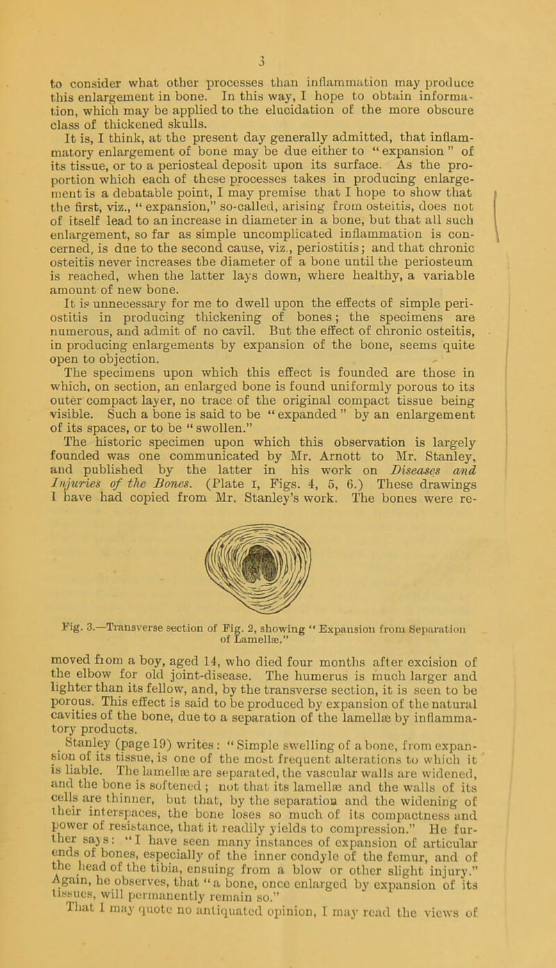 to consider what other processes tliaii inflammation may produce this enlargement in bone. In this way, I hope to obtain informa- tion, which may be applied to the elucidation of the more obscure class of thickened skulls. It is, I think, at the present day generally admitted, that inflam- matory enlargement of bone may be due either to “ expansion ” of its tissue, or to a periosteal deposit upon its surface. As the pro- portion which each of these processes takes in producing enlarge- ment is a debatable point, I may premise that I hope to show that tlie first, viz., “ expansion,” so-called, arising from osteitis, does not of itself lead to an increase in diameter in a bone, but that all such enlargement, so far as simple uncomplicated inflammation is con- cerned, is due to the second cause, viz., periostitis; and that chronic osteitis never increases the diameter of a bone until the periosteum is reached, when the latter lays down, where healthy, a variable amount of new bone. It i.« unnecessary for me to dwell upon the effects of simple peri- ostitis in producing thickening of bones; the specimens are numerous, and admit of no cavil. But the effect of chronic osteitis, in producing enlargements by expansion of the bone, seems quite open to objection. The specimens upon which this effect is founded are those in which, on section, an enlarged bone is found uniformly porous to its outer compact layer, no trace of the original compact tissue being visible. Such a bone is said to be “ expanded ” by an enlargement of its spaces, or to be “ swollen.” The historic .specimen upon which this observation is largely founded was one communicated by Mr. Arnott to Mr. Stanley, and published by the latter in his work on Diseases a/nd Injuries of the Bones. (Plate I, Figs. 4, 6, 6.) These drawings 1 have had copied from Mr. Stanley’s work. The bones were re- Kig. 3.—Transverse section of Fig. 2, showing “ Expansion from Beparatioii of Lamella:.” moved from a boy, aged 14, who died four months after excision of the elbow for old joint-disease. The humerus is much larger and lighter than its fellow, and, by the transverse section, it is seen to be porous. This effect is said to be produced by expansion of the natural cavities of the bone, due to a separation of the lamellm by inflamma- tory products. . Stanley (page 19) writes : “ Simple swelling of a bone, fi om expan- sion of its tissue, is one of the most frequent alterations to which it IS liable. The lamellm are separated, the vascular walls are widened, and the bone is softened ; not that its lamellm and the walls of its cells are thinner, but tliat, by the separation and the widening of their interspaces, the bone loses so much of its compactness and power of resistance, that it readily yields to compression.” He fur- ther sajs: “I have seen many instances of expansion of articular bones, especiall}' of the inner condyle of the femur, and of the head of the tibia, ensuing from a blow or other slight injury.” Again, he observes, that “a bone, once enlarged by expansion of its tissues, will permanently remain so.”