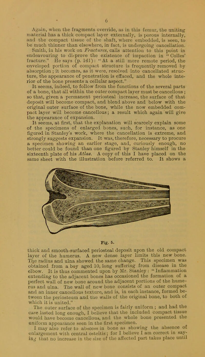 Agiiin, when the fragments override, as in this femur, tlie uniting material has a thick compact layer exteinally, is porous internally, and the compact tissue of the shaft, where embedded, is seen, to be much thinner than elsewhere, in fact, is undergoing cancellation. Smith, in his work on Fraatu/res, calls attention to this point in endeavouring to di.'prove the existence of impaction in “ Colles’ fracture.” He says (p. 1(51); “At a still more remote period, the enveloped portion of compact structure is frequently removed by absorption ; it becomes, as it were, resolved into cancellated struc- ture, the appearance of penetration is effaced, and the whole inte- rior of the bone presents a cellular aspect.” It seems, indeed, to follow from the functions of the several parts of a bone, that all within the outer compact layer must be cancellous ; so that, given a permanent periosteal increase, the surface of that deposit will become compact, and blend above and below with the original outer surface of the bone, while the now embedded com- pact layer will become cancellous; a result which again will give the appearance of expansion. It seems, at first, that the explanation will scarcely explain some of the specimens of enlarged bones, such, for instance, as one figured in Stanley's work, where the cancellation is extreme, and strongly suggests expansion. It was, therefore, necessary to procure a specimen showing an earlier stage, and, curiously enough, no better could be found than one figured by Stanley himself in the sixteenth plate of his Atlas. A copy of this I have placed on the same sheet with the illustration before referred to. It shows a Fig. 6. thick and smooth-surfaced periosteal deposit upon the old compact layer of the humerus. A new dense layer limits this new bone. The radius and ulna showed the same change. This specimen was obtained from a boy aged 10, long suffering from disease in the elbow. It is thus commented upon by' Mr. Stanley : “ Inflammation extending to the adjacent bones has occasioned the formation of a perfect wall of new bone around the adjacent portions of the hume- rus and ulna. The wall of now bone consists of an outer compact and an inner cancellous texture, and is, in each instance, formed be- tween the periosteum and tiie walls of the original bone, to both of which it is united.” The outer surface of the specimen is fairly uniform ; and had the ca.«e lasted long enough, I believe that the included compact tissue would have become cancellous, and the whole bone presented the uniform appearance seen in the first specimen. 1 may also refer to abscess in bone as showing the absence of enlargement with central osteitis ; for 1 believe I am correct in say'- ing that no increase in the size of the affected part takes place until