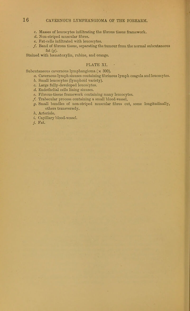 c. Masses of leucocytes infiltrating tlie fibrous tissue framework. d. Nou-striped muscular fibres. e. Fat-cells infiltrated with leucocytes. /. Band of fibrous tissue, separating the tumour from the normal subcutaneous fat (g). Stained with hajmatoxylin, rubiue, and orange. PLATE XI. Subcutaneous cavernous lymphangioma (x 300). a. Cavernous lymph sinuses containing fibrinous lymph coagula and leucocytes. b. Small leucocytes (lymphoid variety). c. Large fully-developed leucocytes. d. Endothelial cells lining sinuses. e. Fibrous-tissue framework containing many leucocytes. f. Trabecular process containing a small blood-vessel. (j. Small bundles of non-striped muscular fibres cut, some longitudinally, others transversely. h. Arteriole. i. Capillary blood-vessel. j. Fat.