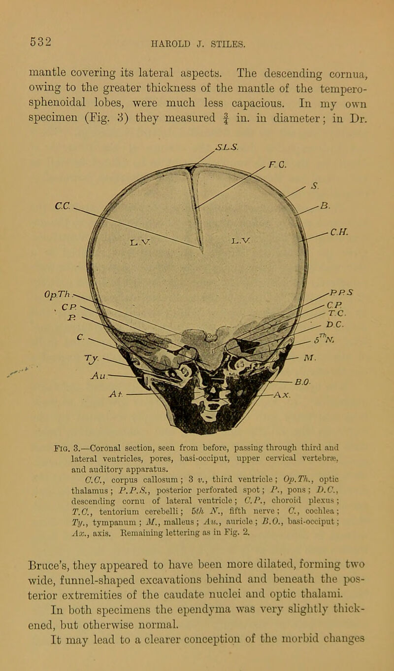 mantle covering its lateral aspects. The descending cornua, owing to the greater thickness of the mantle of the tempero- sphenoidal lobes, were much less capacious. In my own specimen (Fig. 3) they measured f in. in diameter; in Dr. SLS. Fig, 3.—Coronal section, seen from before, passing through third .and lateral ventricles, pores, basi-occiput, upper cervical vertebne, and auditory apparatus. C.C., corpus callosum; 3 v., third ventricle; Op.Th., optic thalamus; P.P.S., posterior perforated spot; P., pons; D.C., descending cornu of lateral ventricle; C.P., choroid plexus; T.C., tentorium cerebelli; 6ih AL, fifth nerve: C., cochlea; Ty., tympanum ; M., malleus; Au., auricle; B.O., basi-occiput; Ax., axis. Remaining lettering as in Fig. 2. Bruce’s, they appeared to have been more dilated, forming two wide, funnel-shaped excavations behind and beneath the pos- terior extremities of the caudate nuclei and optic thalarai. In both specimens the ependyma was very sliglitly thick- ened, but otherwise normal. It may lead to a clearer conception of the morbid changes
