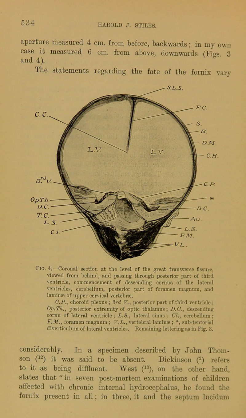 aperture measured 4 cm. from before, backwards; in my own case it measured 6 cm. from above, downwards (Figs. 3 and 4). The statements regarding the fate of the fornix vary Fig. 4.—Coronal section at tlie level of the great transverse fissure, viewed from behind, and passing through posterior part of third ventricle, commencement of descending cornua of the lateral ventricles, cerebellum, posterior part of foramen magnum, and laminee of upper cervical vertebrfe. G.P., choroid plexus ; 3r<f F., posterior part of third ventricle ; Op.Th., posterior extremity of optic thalamus; B.C., descending cornu of lateral ventricle; L.S., lateral sinus; 01., cerebellum; F.M., foramen magnum ; V.L., vertebral laniinte ; *, sub-tentorial diverticulum of lateral ventricles. Remaining lettering as in Fig. 3. considerably. In a specimen described by John Thom- son it was said to be absent. Dickinson (-) refers to it as being diffluent. West (^®), on the other liand, states that “ in seven post-mortem examinations of children affected with chronic internal hydrocephalus, he found the fornix present in all; in three, it and the septum lucidum