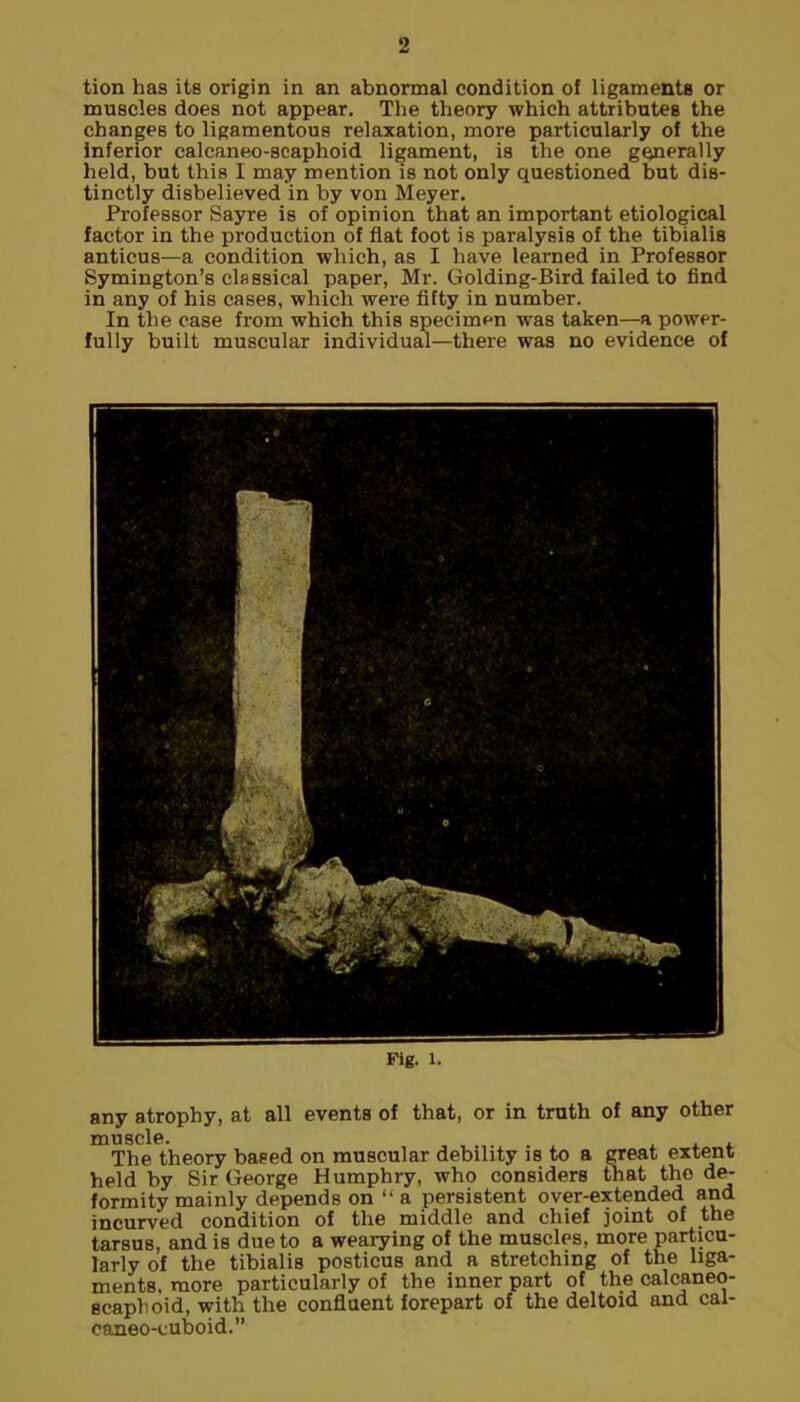 tion has its origin in an abnormal condition of ligaments or muscles does not appear. The theory which attributes the changes to ligamentous relaxation, more particularly of the inferior calcaneo-scaphoid ligament, is the one generally held, but this I may mention is not only questioned but dis- tinctly disbelieved in by von Meyer. Professor Sayre is of opinion that an important etiological factor in the production of flat foot is paralysis of the tibialis anticus—a condition which, as I have learned in Professor Symington’s classical paper, Mr. Golding-Bird failed to find in any of his cases, which were fifty in number. In the case from which this specimen was taken—a power- fully built muscular individual—there was no evidence of Fig. 1. any atrophy, at all events of that, or in truth of any other muscle. . The theory based on muscular debility is to a great extent held by Sir George Humphry, who considers that the de- formity mainly depends on “ a persistent over-extended and incurved condition of the middle and chief joint of the tarsus, and is due to a wearying of the muscles, more particu- larly of the tibialis posticus and a stretching of the liga- ments, more particularly of the inner part of the calcaneo- scaphoid, with the confluent forepart of the deltoid and cal- caneo-cuboid.”