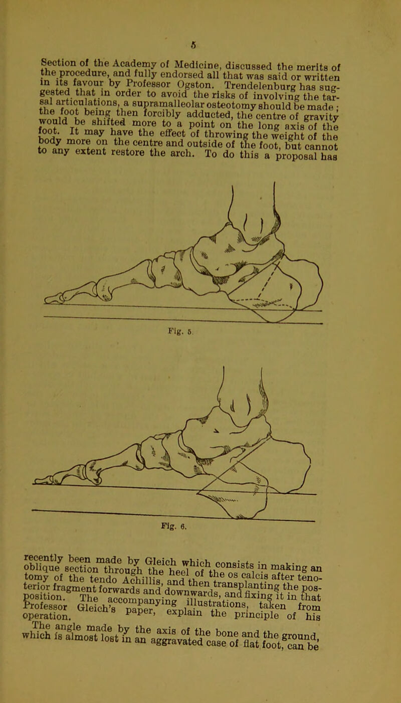 Section of the Academy of Medicine, discussed the merits of the procedure and fully endorsed all that was said or written “ j£L f,a,v0,ur hy Professor Ogston. Trendelenburg has sug- gested that in order to avoid the risks of involving the tar- ?^aE5Sni.a*,0nV suPra™alleoIar osteotomy should be made : ! ,iH tbev?( Jen forcibly adducted, the centre of gravity wouid be shifted more to a point on the long axis of the foot. It may have the effect of throwing the weight of the m°rt °? th? cent?e and outside of the foot, but cannot to any extent restore the arch. To do this a proposal has oblique7sectioif^rough ^he^heel^f^hp11818^ making an tomy of the tendo Sllis andthlrS* 03 C?lciJ after teno- terior fragment forwards and’dnwnro61^^18,118?!?11^111^ P°s- position. The accompanying Inustratton^^i^ infthat Professor Gleich’s paper elnloin •’ taken hom operation. pp’ explain the principle of his wS! an^Svate^caLTf ffat $St*2£&