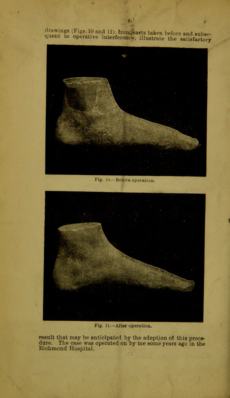 8/ < drawings (Figs. 10 and 11). frdtt&asts taken before and subse- quent to operative interference, illustrate the satisfactory Fig. 11.—After operation. I result that may be anticipated by the adoption of this proce- dure. The case was operated on by me some years ago in the Richmond Hospital. I