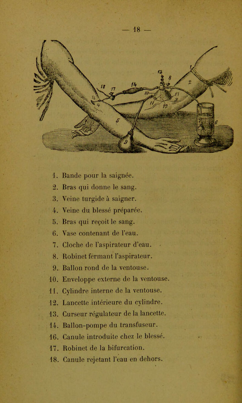 18 — 1. Bande pour la saignee. 2. Bras qui donne le sang. 3. Veine turgide a saigner. 4. Veine du blesse preparee. 5. Bras qui re^oit le sang. 6. Vase contenant de l’eau. 7. Cloche de l’aspirateur d’eau. - 8. Robinet fermant l’aspirateur. 9. Ballon rond de la ventouse. 10. Enveloppe externe de la ventouse. 11. Cylindre interne de la ventouse. 12. Lancette interieure du cylindre. 13. Curseur regulateur de la lancette. 14. Ballon-pompe du transfuseur. 16. Canule introduce chez le blesst1. 17. Robinet de la bifurcation. \ . Uii