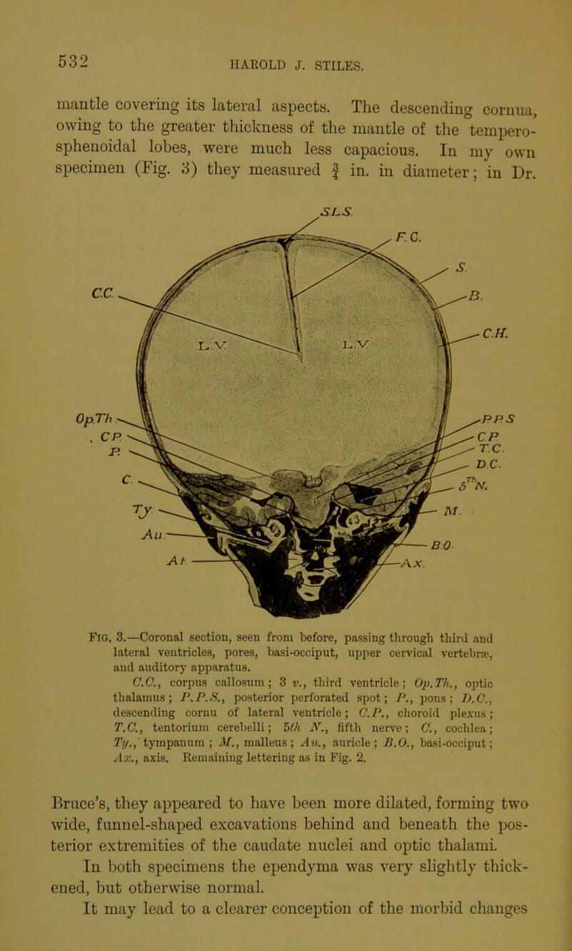 mantle covering its lateral aspects. The descending cornua, owing to the greater thickness of the mantle of the tempero- sphenoidal lobes, were much less capacious. In my own specimen (Fig. 3) they measured f in. in diameter; in Dr. SPS Fig. 3.—Coronal section, seen from before, passing through third and lateral ventricles, pores, basi-occiput, upper cervical vertebrae, and auditory apparatus. (7.(7., corpus callosum; 3 v., third ventricle; Op.Th., optic thalamus; P.P.S., posterior perforated spot; P., pons; D.C., descending cornu of lateral ventricle; C.P., choroid plexus; T.C., tentorium cerebelli; 5th N., fifth nerve; C., cochlea; Ty., tympanum ; M., malleus; Au., auricle; B.O., basi-occiput; Ax., axis. Remaining lettering as in Fig. 2. Bruce’s, they appeared to have been more dilated, forming two wide, funnel-shaped excavations behind and beneath the pos- terior extremities of the caudate nuclei and optic thalami. In both specimens the ependyma was very slightly thick- ened, but otherwise normal. It may lead to a clearer conception of the morbid changes