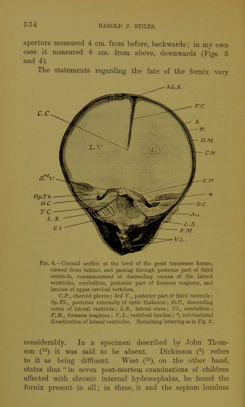 aperture measured. 4 cm. from before, backwards; in my own case it measured 6 cm. from above, downwards (Figs. 3 and 4). The statements regarding the fate of the fornix vary Fig. 4.—Coronal section at the level of the great transverse fissure, viewed from behind, and passing through posterior part of third ventricle, commencement of descending cornua of the lateral ventricles, cerebellum, posterior part of foramen magnum, and laminre of upper cervical vertebrae. C. P., choroid plexus ; 3rd V., posterior part of third ventricle ; Op.Th,, posterior extremity of optic thalamus; D.O., descending cornu of lateral ventricle; L.S., lateral sinus; Cl., cerebellum; F.M., foramen magnum ; V.L., vertebral laminse ; *, sub-tentorial diverticulum of lateral ventricles. Remaining lettering as in Fig. 3. considerably. In a specimen described by John Thom- son (12) it was said to be absent. Dickinson (2) refers to it as being diffluent. West (13), on the other hand, states that “ in seven post-mortenp. examinations of children affected with chronic internal hydrocephalus, he found the fornix present in all; in three, it and the septum lucidum