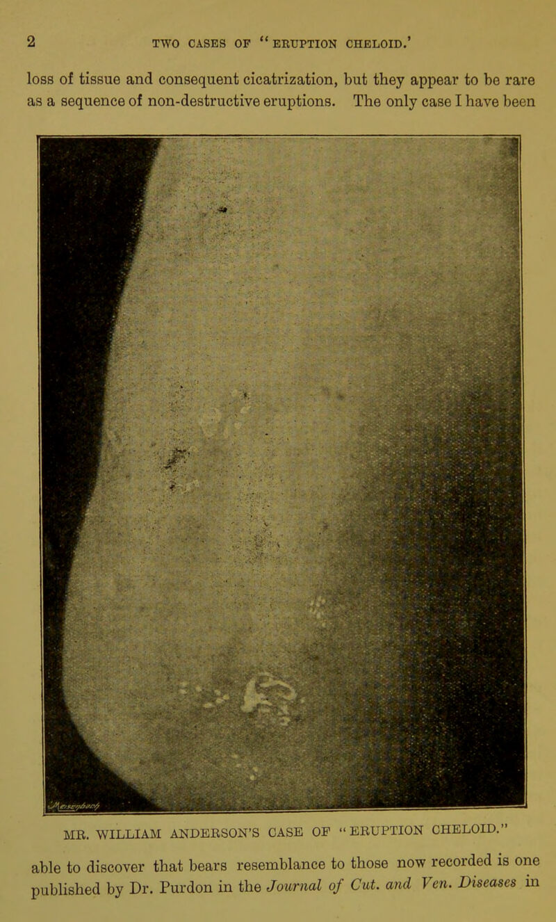 loss of tissue and consequent cicatrization, but they appear to be rare as a sequence of non-destructive eruptions. The only case I have been MR. WILLIAM ANDERSON’S CASE OF “ERUPTION CHELOID.” able to discover that bears resemblance to those now recoided is one published by Dr. Purdon in the Journal of Cut. and I en. Diseases in