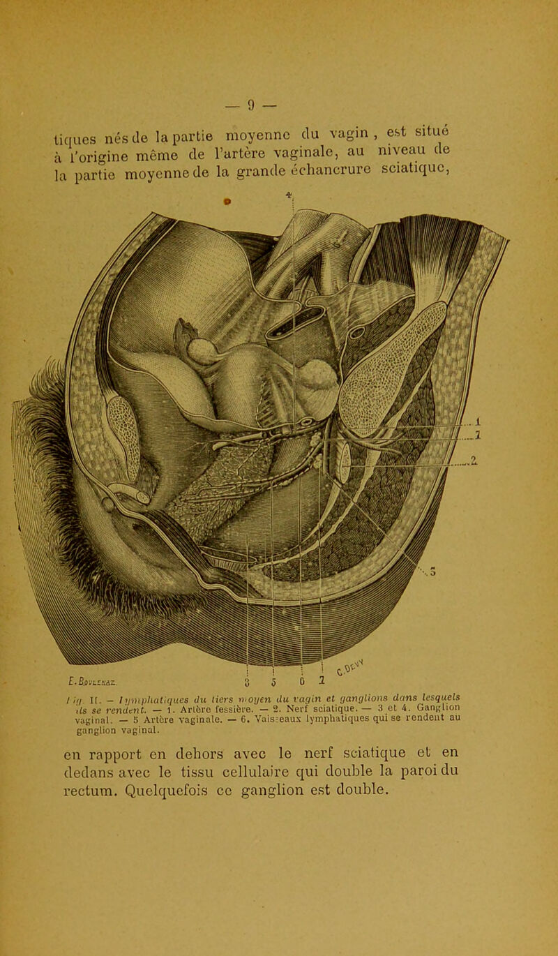 tiques nestle la partie moyennc du vagin, est situe a l’origine meme de l’artere vaginale, au niveau tie la partie moyennede la grande echancrure sciatiquc, / ,7/ k. - tymphatiqu.es du tiers moyen du vagin el ganglions dans lesquels Us se rendent. — 1. Arlero fessifei'e. — 2. Nerf sciatique. — 3 et 4. Ganglion vaginal. — 5 Arlere vaginale. — 6. Vuis:eaux lymphatiques qui se rendent au ganglion vaginal. en rapport en dehors avec le nerf sciatique et en dedans avec le tissu cellulaire qui double la paroi du rectum. Quelquefois cc ganglion est double.