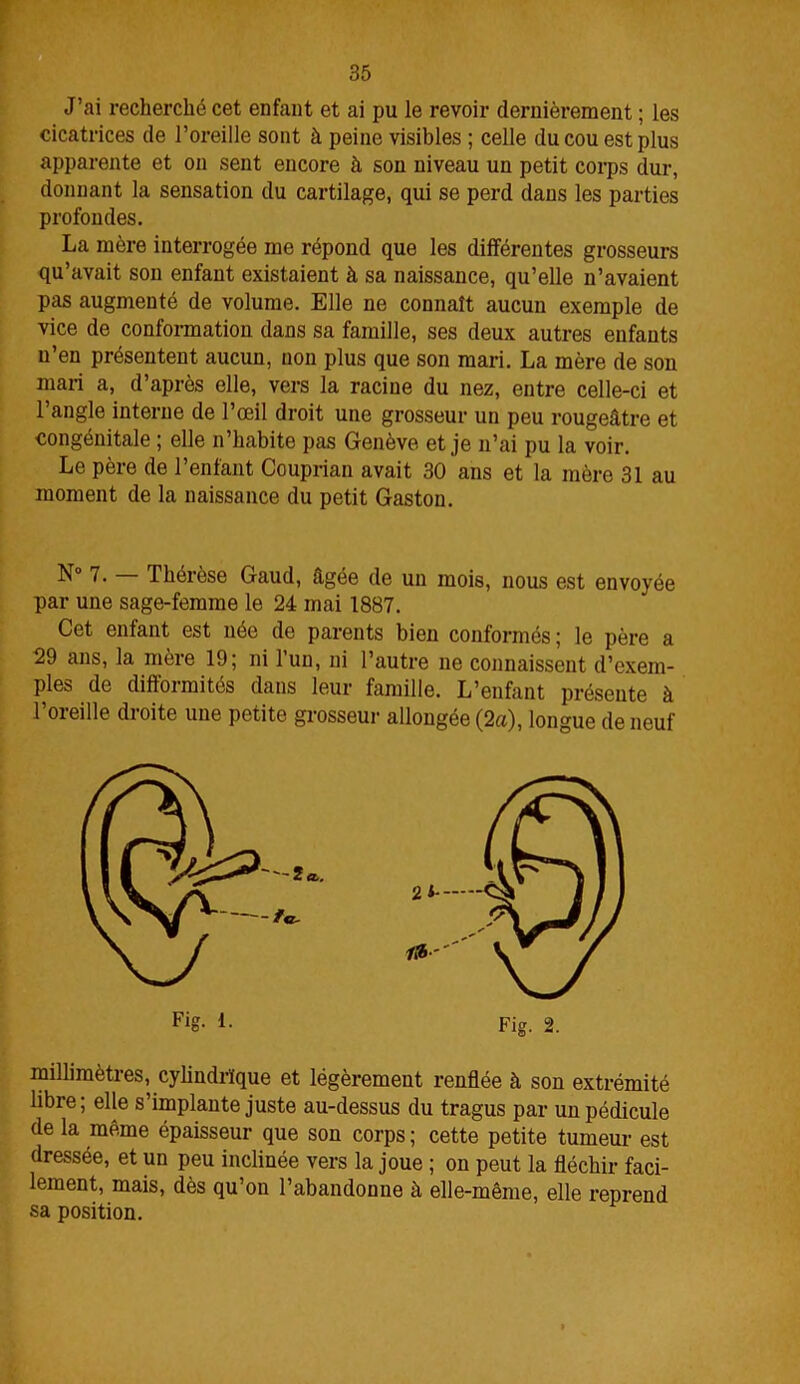 J’ai recherché cet enfant et ai pu le revoir dernièrement ; les cicatrices de l’oreille sont à peine visibles ; celle du cou est plus apparente et on sent encore à sou niveau un petit corps dur, donnant la sensation du cartilage, qui se perd dans les parties profondes. La mère interrogée me répond que les différentes grosseurs qu’avait son enfant existaient à sa naissance, qu’elle n’avaient pas augmenté de volume. Elle ne connaît aucun exemple de vice de conformation dans sa famille, ses deux autres enfants n’en présentent aucun, non plus que son mari. La mère de son mari a, d’après elle, vers la racine du nez, entre celle-ci et l’angle interne de l’œil droit une grosseur un peu rougeâtre et congénitale ; elle n’habite pas Genève et je n’ai pu la voir. Le père de l’enfant Couprian avait 30 ans et la mère 31 au moment de la naissance du petit Gaston. N° 7. — Thérèse Gaud, âgée de un mois, nous est envoyée par une sage-femme le 24 mai 1887. Cet enfant est née de parents bien conformés ; le père a 29 ans, la mère 19; ni lun, ni l’autre ne connaissent d’exem- ples de difformités dans leur famille. L’enfant présente à l’oreille droite une petite grosseur allongée (2a), longue de neuf F»g- L Fig. 2. millimètres, cylindrique et légèrement renflée à son extrémité libre; elle s’implante juste au-dessus du tragus par un pédicule de la même épaisseur que son corps ; cette petite tumeur est dressée, et un peu inclinée vers la joue ; on peut la fléchir faci- lement, mais, dès qu’on l’abandonne à elle-même, elle reprend sa position.