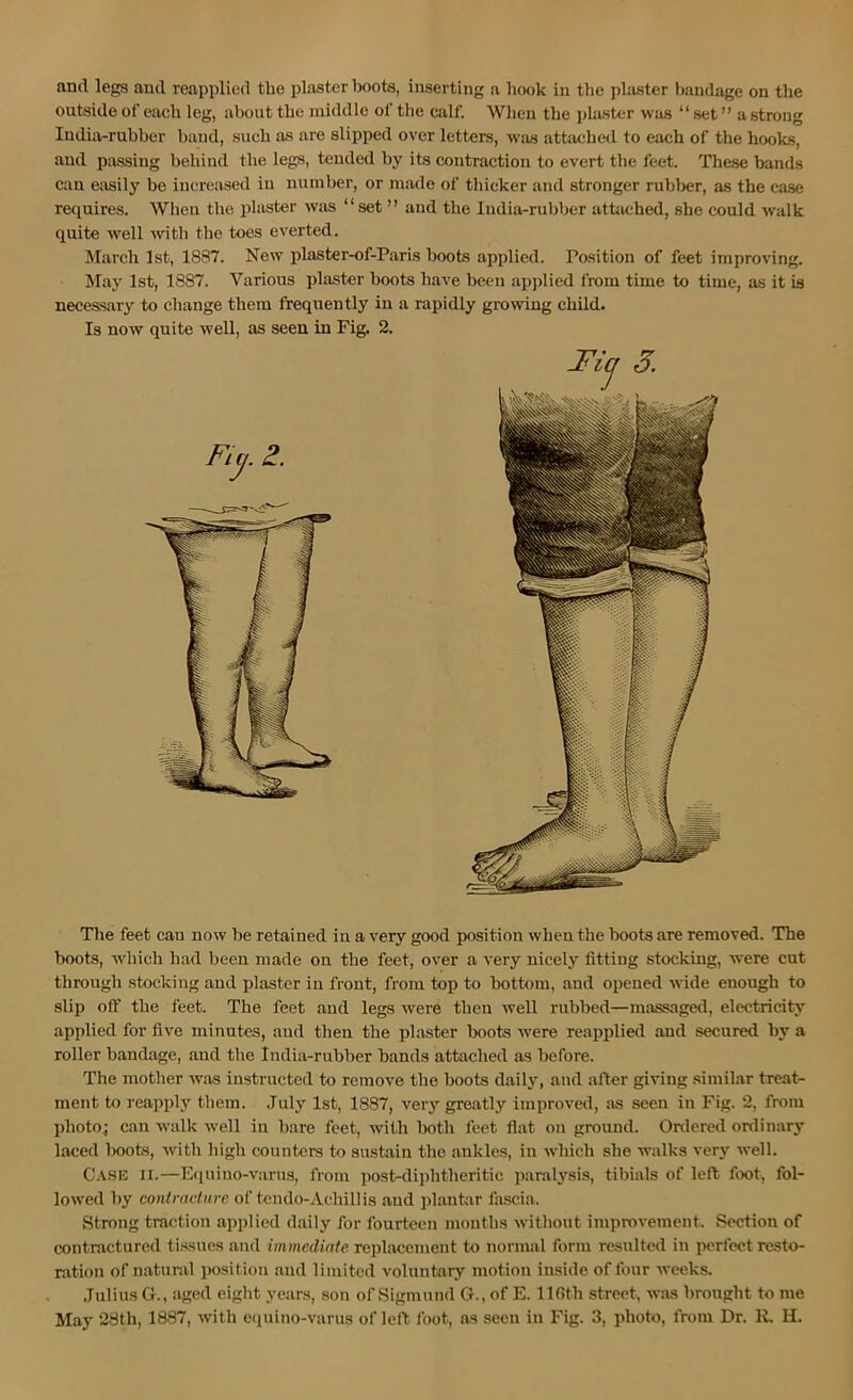 outside of each leg, about the middle of the calf. When the plaster was “ set ” a strong ludiarrubber band, .such as are slipped over letters, was attached to each of the hooks, and piissing behind the legs, tended by its contraction to evert the feet. These bands can easily be increased in number, or made of thicker and stronger rubber, as the case reejuires. Wlieu the j)laster wfis “set ” and the India-rubijer atttiched, she could walk quite well with the toes everted. March 1st, 1887. New plaster-of-Paris boots applied. Position of feet improving. May 1st, 1887. Various plaster boots have been applied from time to time, as it is necessary to change them frequently in a rapidly grooving child. Is now quite well, as seen in Fig. 2. The feet can now be retained in a very good position when the boots are removed. The boots, which had been made on the feet, over a very nicelj’’ fitting stocking, were cut through stocking and plaster in front, from top to bottom, and opened Avide euongh to slip off the feet. The feet and legs were then well rubbed—massaged, electricity applied for five minutes, and then the plaster boots were reapplied and secured by a roller bandage, and the India-rubber bands attached as before. The mother wiis instructed to remove the boots daily, and after giving similar treat- ment to reapply them. July 1st, 1887, very greatly improved, as seen in Fig. 2, from photo; can walk Avell in bare feet, Avith both feet flat on ground. Onlcred ordinary laced lxK)ts, Avith high counters to sustain the ankles, in Avhich she Avalks very Avell. C.A.SE II.—E(iuino-varus, from post-diplitheritic paralysis, tibials of left fix)t, fol- loAved by contracture of tendo-Achillis and plantar fascia. Strong traction applied daily for fourteen months Avithout improvement. Section of contractured ti.ssues and immediate replacement to normal form resulted in perfect resto- ration of natural position and limited voluntary motion inside of four Aveeks. Jtdius G., aged eight years, son of Sigmund G., of E. lldth street, AA-.as brought to me May 28th, 1887, Avith equino-varus of left foot, as seen in Fig. 3, photo, from Dr. R. H.