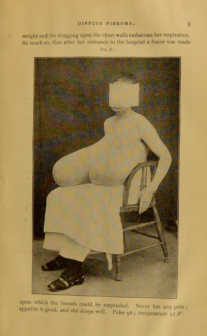 weight and the dragging upon the chest-walls embarrass her respiration. So much so, that after her entrance to the hospital a frame was made Fiu. 2. upon which the breasts could be suspended, appetite is good, and she sleeps well. Pulse 96; Never has any pain ; temperature 97.8°.