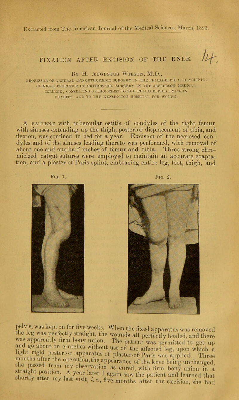 Extracted from The American Journal of the Medical Sciences, March, 1893. FIXATION AFTER EXCISION OF THE KNEE. By H. Augustus Wilson, M.D., l'ROFESSOIt OF GENERAL AND ORTHOP2EDIC SURGERY IN THE PHILADELPHIA POLYCLINIC; CLINICAL PROFESSOR OF 011TII0P.EDIC SURGERY IN THE JEFFERSON MEDICAL COLLEGE ; CONSULTING ORTHOPAEDIST TO THE PHILADELPHIA LYING-IN CHARITY, AND TO THE KENSINGTON HOSPITAL FOR WOMEN. A patient with tubercular ostitis of condyles of the right femur with sinuses extending up the thigh, posterior displacement of tibia, and flexion, was confined in bed for a year. Excision of the necrosed con- dyles and of the sinuses leading thereto was performed, with removal of about one and one-half inches of femur and tibia. Three strong chro- micized catgut sutures were employed to maintain an accurate coapta- tion, and a plaster-of-Paris splint, embracing entire leg, foot, thigh, and Fig. 1. Fig. 2. elv s, was kept on for five,weeks. When the fixed apparatus was removed the leg was perfectly straight, the wounds all perfectly healed, and there was apparently firm bony union. The patient was permitted to get up and go about on crutches without use of the affected leg, upon which a lght rigid posterior apparatus of plaster-of-Paris was applied. Three on is a ter le operation, the appearance of the knee being unchanged, sfpqiSTl-!-m] '7 ob8e1rvatioTn as.cured, with firm bony union in a short!v L' >n / a.ter ^ again saw the patient and learned that shortly after my last visit, ie., five months after the excision, she had