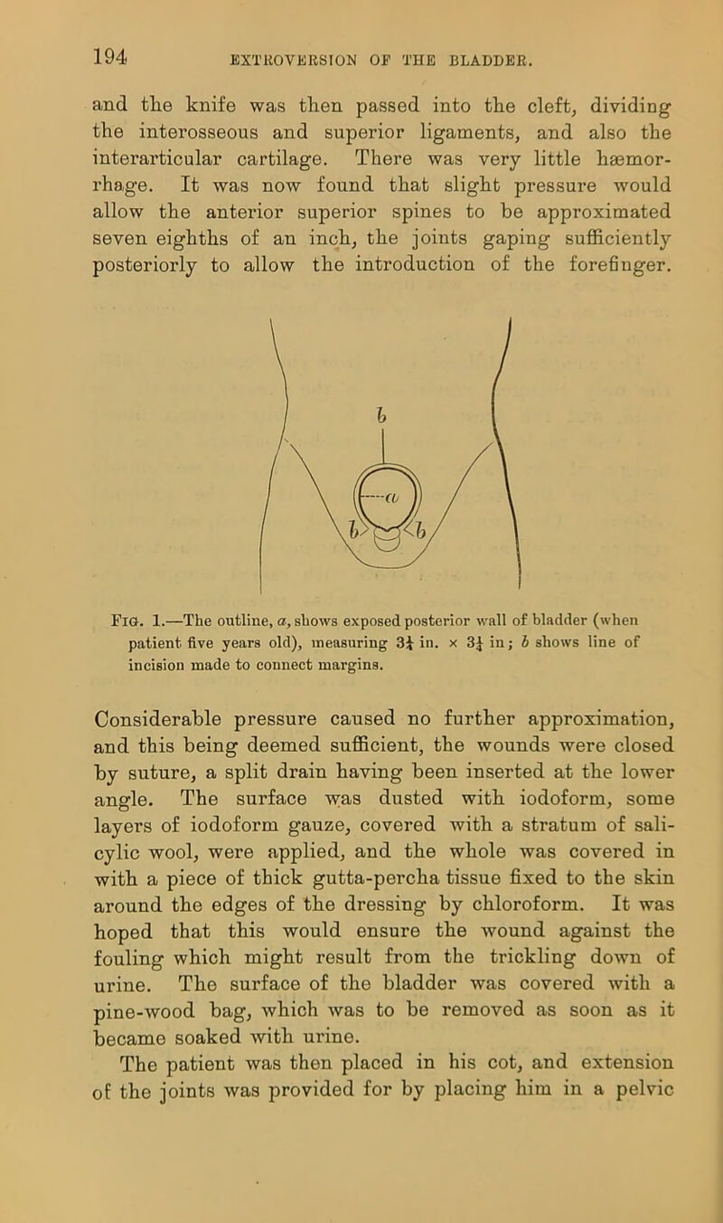 and the knife was then passed into the cleft, dividing the interosseous and superior ligaments, and also the interarticular cartilage. There was very little haemor- rhage. It was now found that slight pressure would allow the antei'ior superior spines to be approximated seven eighths of an inch, the joints gaping sufficiently posteriorly to allow the introduction of the forefinger. Fig. 1.—The outline, a, shows exposed posterior wall of bladder (when patient five years old), measuring 3\ in. x 3^ in; b shows line of incision made to connect margins. Considerable pressure caused no further approximation, and this being deemed sufficient, the wounds were closed by suture, a split drain having been inserted at the lower angle. The surface was dusted with iodoform, some layers of iodoform gauze, covered with a stratum of sali- cylic wool, were applied, and the whole was covered in with a piece of thick gutta-percha tissue fixed to the skin around the edges of the dressing by chloroform. It was hoped that this would ensure the wound against the fouling which might result from the trickling down of urine. The sui'face of the bladder was covered with a pine-wood bag, which was to be removed as soon as it became soaked with urine. The patient was then placed in his cot, and extension of the joints was provided for by placing him in a pelvic