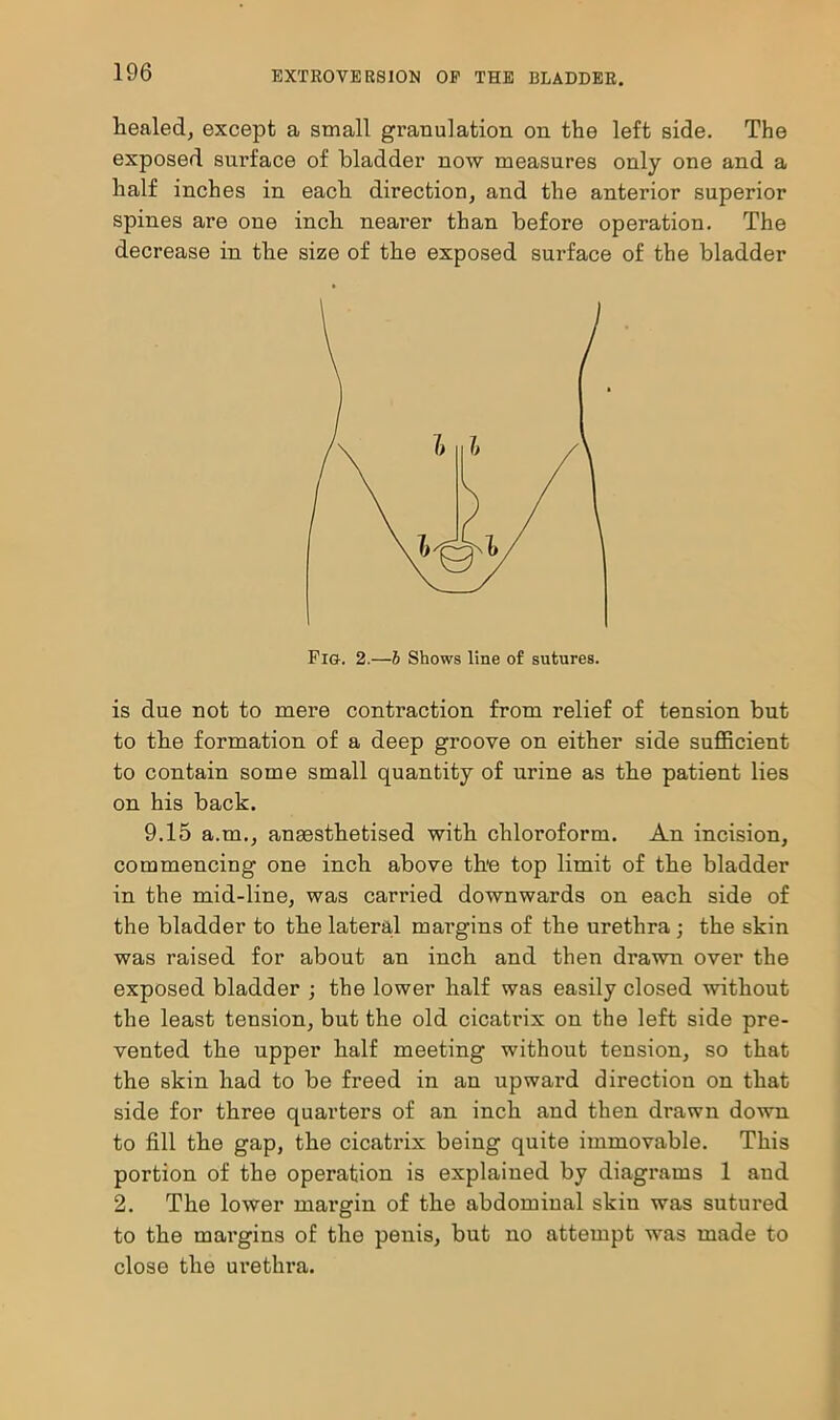 healed, except a small granulation on the left side. The exposed surface of bladder now measures only one and a half inches in each direction, and the anterior superior spines are one inch nearer than before operation. The decrease in the size of the exposed surface of the bladder Fig. 2.—b Shows line of sutures. is due not to mere contraction from relief of tension but to the formation of a deep groove on either side sufficient to contain some small quantity of urine as the patient lies on his back. 9.15 a.m., anaesthetised with chloroform. An incision, commencing one inch above the top limit of the bladder in the mid-line, was carried downwards on each side of the bladder to the lateral margins of the urethra ; the skin was raised for about an inch and then drawn over the exposed bladder ; the lower half was easily closed •without the least tension, but the old cicatrix on the left side pre- vented the upper half meeting without tension, so that the skin had to be freed in an upward direction on that side for three quarters of an inch and then drawn down to fill the gap, the cicatrix being quite immovable. This portion of the operation is explained by diagrams 1 and 2. The lower margin of the abdominal skin was sutured to the margins of the penis, but no attempt was made to close the urethra.