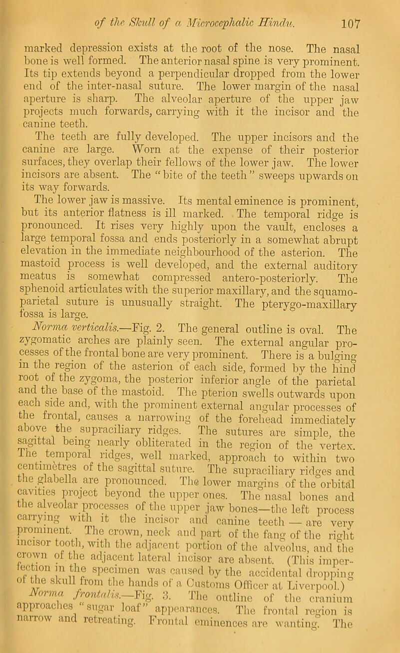 marked depression exists at the root of the nose. The nasal bone is well formed. The anterior nasal spine is very prominent. Its tip extends beyond a perpendicular dropped from the lower end of the inter-nasal suture. The lower margin of the nasal aperture is sliarp. The alveolar aperture of the upper jaw projects much forwards, carrying with it the incisor and the canine teeth. The teeth are fully developed. The upper incisors and the canine are large. Worn at the expense of their posterior surfaces, they overlap their fellows of the lower jaw. The lower incisors are absent. The “bite of the teeth” sweeps upwards on its way forwards. The lower jaw is massive. Its mental eminence is prominent, but its anterior flatness is ill marked. The temporal ridge is pronounced. It rises very highly upon the vault, encloses a large temporal fossa and ends posteriorly in a somewhat abrupt elevation in the immediate neighbourhood of the asterion. The mastoid process is well developed, and the external auditory meatus is somewhat compressed antero-posteriorly. The sphenoid articulates with the superior maxillary, and the squamo- parietal suture is unusually straight. The pterygo-maxillary fossa is large. Norma veodiGaUs.—Fig. 2. The general ontline is oval. The zygomatic arches are plainly seen. The external angular pro- cesses of the frontal bone are very prominent. There is a bulging- in the region of the asterion of each side, formed by the hind root of the zygoma, the posterior inferior angle of the parietal and the base of the mastoid. The pterion swells outwards upon each side and, with the prominent external angular processes of the frontal, causes a narrowing of the forehead immediately above the supraciliary ridges. The sutures are simple, the s^ittal being nearly obliterated in the region of the vertex. 1 he temporal ridges, well marked, approach to within two centimetres of the sagittal suture. The supraciliary ridges and the glabella are pronounced. The lower margins of the orbital cavities project beyond the upper ones. The nasal bones and the alveolar processes of the upper jaw bones—the left process carrying with it the incisor and canine teeth — are very prominent. The crown, neck and part of the fang of the right incisor tooth, with the adjacent portion of the alveolus, and the crown ot the adjacent lateral incisor are absent. (This imper- tection in the specimen was caused by the accidental dropiiing of the skull from the hands of a Customs Officer at Liverpool.) oima fiontalis. Fig. 3. The outline of the cranium approac les sugar loaf ap])earaiices. The frontal region is narrow and retreating. Frontal eminences are wanting. The