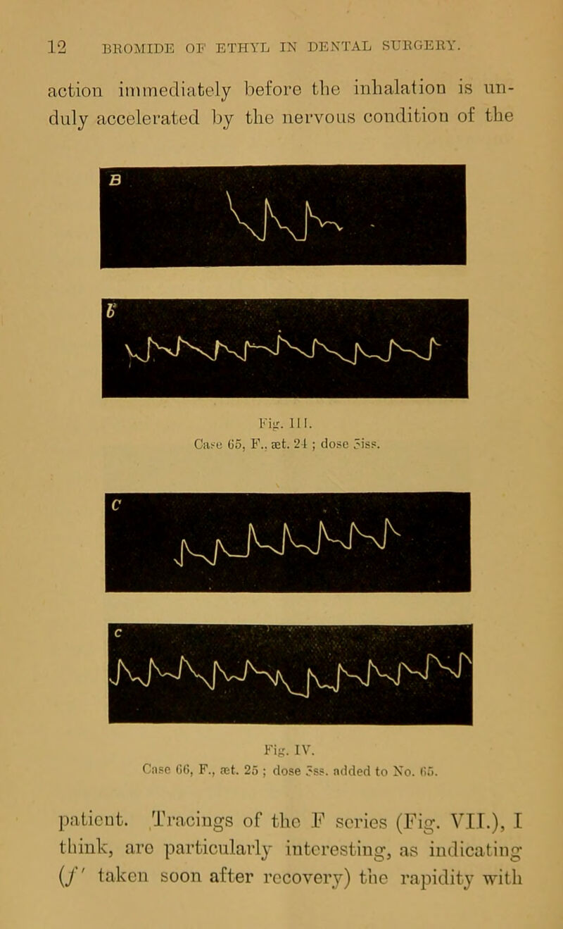 action immediately before the inhalation is un- duly accelerated by the nervous condition of the Ki>r. III. Case G5, F.. set. 24 ; dose 5iss. Fig. IV. Case G(5, F., aet. 25 ; dose 3ss. added to No. (i5. patient. Tracings of the .F scries (Fig. VII.), I think, are particularly interesting, as indicating {J ' taken soon after recovery) the rapidity with