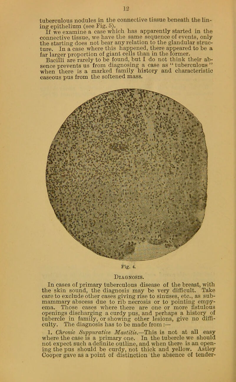 tuberculous nodules in the connective tissue beneath the lin- ing epithelium (see Fig. 5). If we examine a case which has apparently started in the connective tissue, we have the same sequence of events, only the starting does not bear any relation to the glandular struc- ture. In a case where this happened, there appeared to be a far larger proportion of giant cells than in the former. Bacilli are rarely to be found, but I do not think their ab- sence prevents us from diagnosing a case as “tuberculous” when there is a marked family history and characteristic caseous pus from the softened mass. Diagnosis. In cases of primary tuberculous disease of the breast, with the skin sound, the diagnosis may be very difficult. Take care to exclude other cases giving rise to sinuses, etc., as sub- mammary abscess due to rib necrosis or to pointing empy- ema. Those cases where there are one or more fistulous openings discharging a curdy pus, and perhaps a history of tubercle in family, or showing other lesions, give no diffi- culty. The diagnosis has to be made from:— 1. Chronic Suppurative Mastitis.—This is not at all easy where the case is a primary one. In the tubercle we should not expect such a definite outline, and when there is an open- ing the pus should be curdy, not thick and yellow. Astley Cooper gave as a point of distinction the absence of tender-