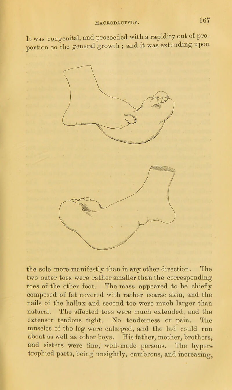 It was congenital, and proceeded with, a rapidity out of pro- portion to the general growth ; and it was extending upon the sole more manifestly than in any other direction. The two outer toes were rather smaller than the corresponding toes of the other foot. The mass appeared to he chiefly composed of fat covered with rather coarse skin, and the nails of the hallux and second toe were much larger than natural. The affected toes were much extended, and the extensor tendons tight. No tenderness or pain. The muscles of the leg were enlarged, and the lad could run about as well as other boys. His father, mother, brothers, and sisters were fine, well-made persons. The hyper- trophied parts, being unsightly, cumbrous, and increasing,