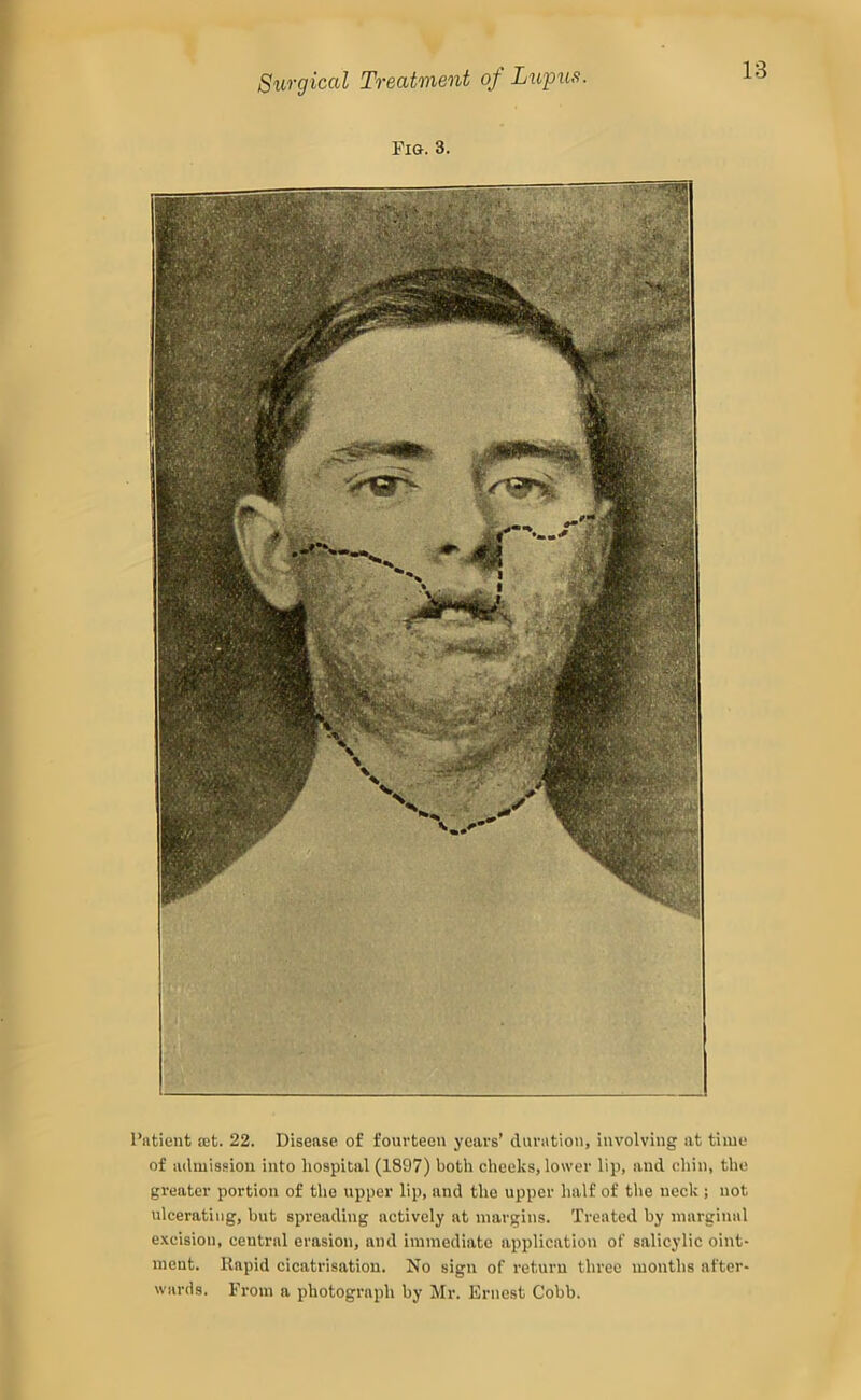 Pig. 3. Patient set. 22. Disease of fouvteeu years’ duration, involving at time of admission into hospital (1897) both cheeks, lower lip, and (diin, the greater portion of the upper lip, and the upper half of the neck ; not ulcerating, but spreading actively at margins. Treated by marginal e.'ceision, central erasion, and immediate application of salicylic oint- ment. Rapid cicatrisation. No sign of return three months after- wards. From a photograph by Mr. Ernest Cobb.