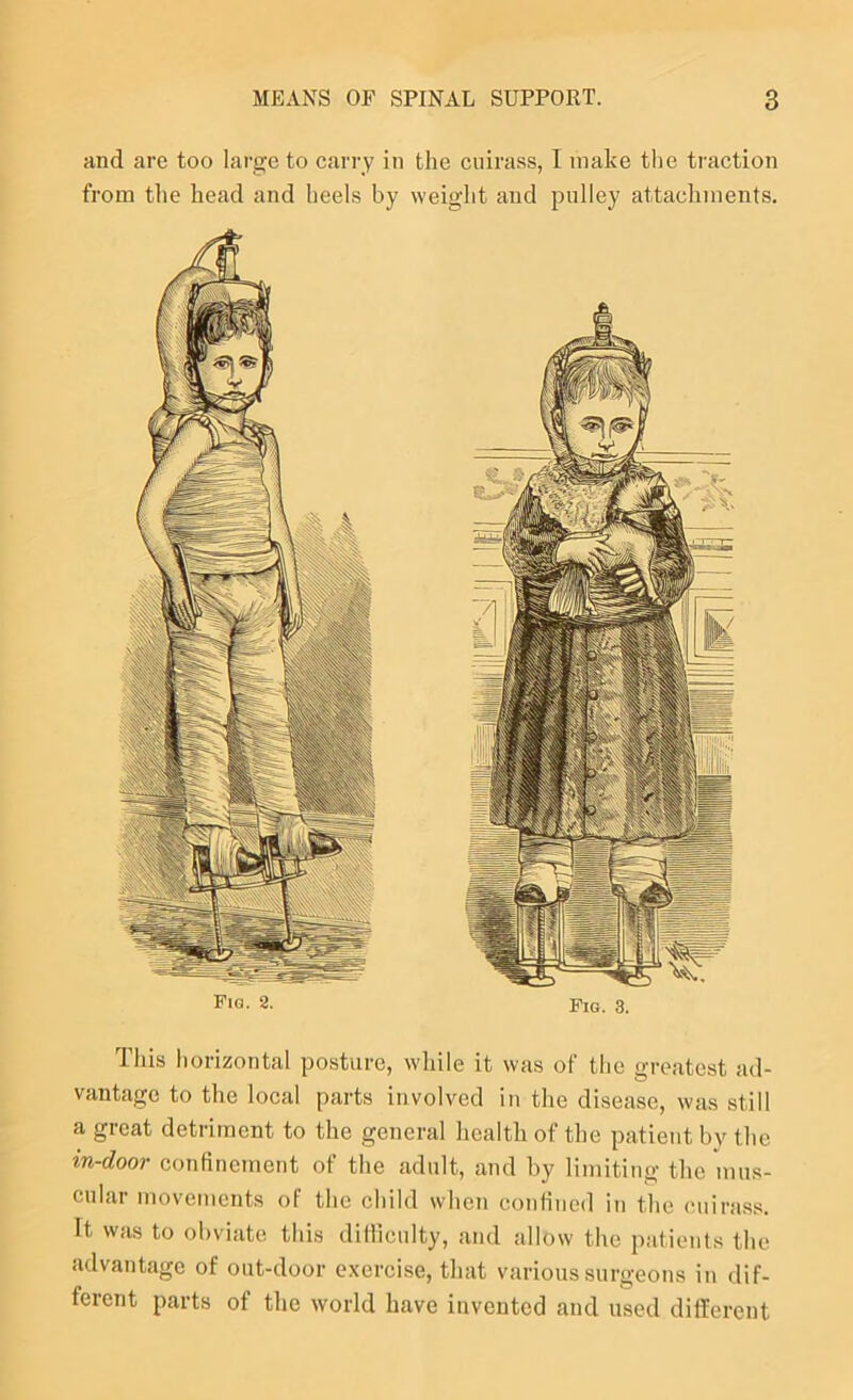 and are too large to earry in the cuirass, I make the traction from tlie head and heels by weight and pulley attachments. This horizontal posture, while it was of the greatest ad- vantage to the local parts involved in the disease, was still a great detriment to the general health of the patient by the in-door confinement of the adult, and by limiting the mus- cular movements of the child when confined in the cuirass. It was to obviate this difliculty, and allow the patienls the advantage of out-door exercise, that various surgeons in dif- ferent parts of the world have invented and used different Fia. 8. Fig. 3.