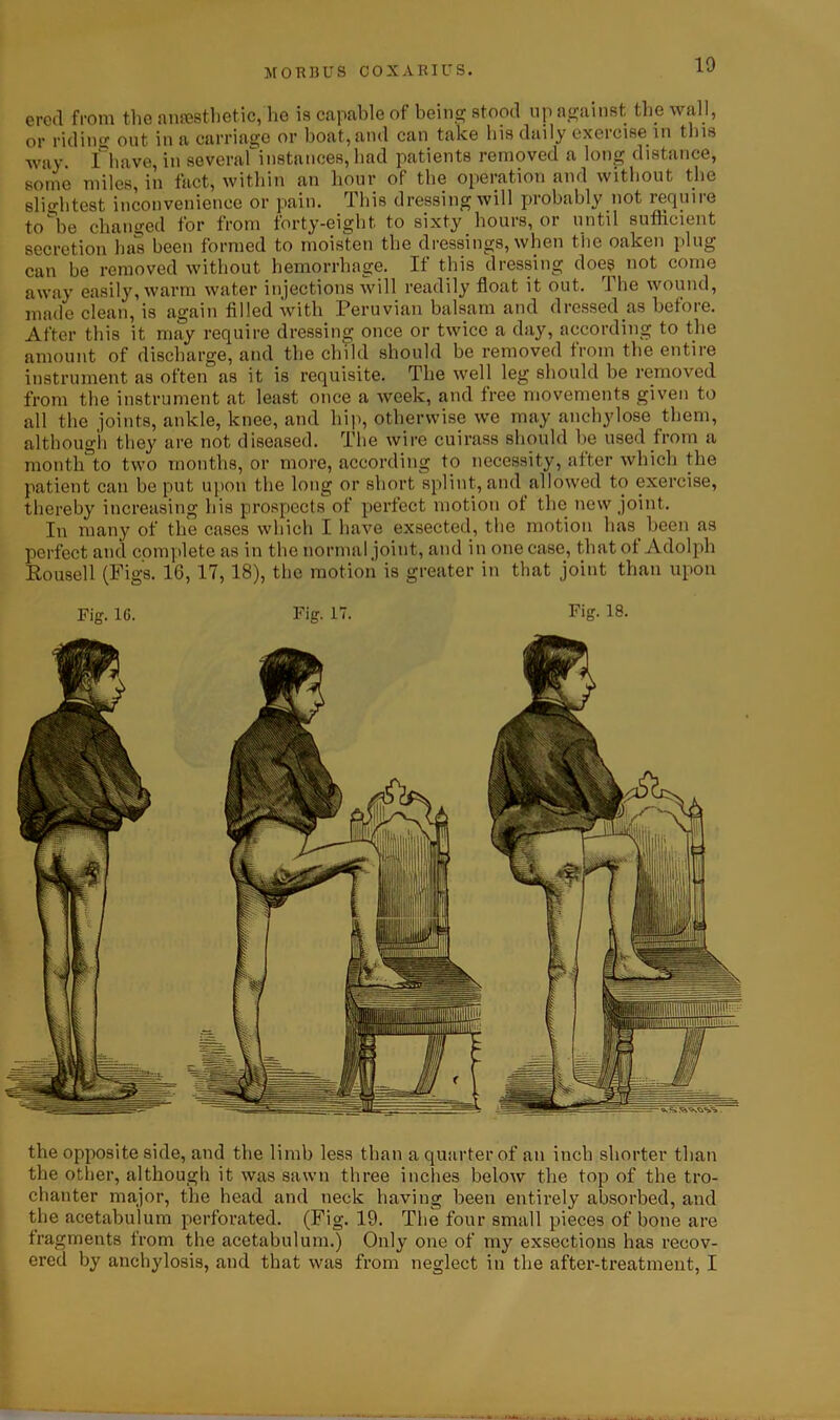 the opposite side, and the limb less than a quarter of an inch shorter than the other, although it was sawn three inches below the top of the tro- chanter major, the head and neck having been entirely absorbed, and the acetabulum perforated. (Fig. 19. The four small pieces of bone are fragments from the acetabulum.) Only one of my exsections has recov- ered by anchylosis, and that was from neglect in the after-treatment, I ercd from the anesthetic, he is capable of being stood up against the wall, or riding out in a carriage or boat, and can take his daily exercise in this way. I^have, in severaf instances, had patients removed a long distance, some miles, in fact, within an hour of the operation and without the slightest inconvenience or pain. This dressing will probably not require to^be changed for from forty-eight to sixty hours, or until sufficient secretion has been formed to moisten the dressings, when the oaken plug can be removed without hemorrhage. If this dressing does not come away easily, warm water injections will readily float it out. 1 he wound, made clean, is again filled with Peruvian balsam and dressed as before. After this it may require dressing once or twice a day, according to the amount of discharge, and the child should be removed from the entire instrument as often as it is requisite. The well leg should be removed from the instrument at least once a week, and free movements given to all the joints, ankle, knee, and hip, otherwise we may anchylose them, although they are not diseased. The wire cuirass should be used from a month to two months, or more, according to necessity, after which the patient can be put upon the long or short splint, and allowed to exercise, thereby increasing his prospects of perfect motion of the new joint. In many of the cases which I have exsected, the motion has been as perfect and complete as in the normal joint, and in one case, that of Adolph Housed (Figs. 16,17,18), the motion is greater in that joint than upon Fig. 16. Fig. 17. Fig. 18.