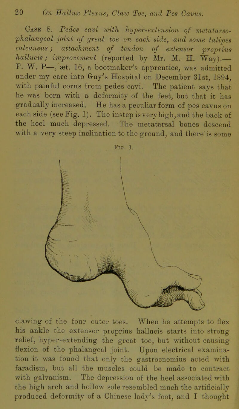 Case 8. Pedes cavi with hyper-extension of metatarso- phalangeal joint of great toe on each side, and some talipes calcaneus; attachment of tendon of extensor proprius hallucis; improvement (reported by Mr. M. H. Way).— F. W. P—, set. 16, a bootmaker’s apprentice, was admitted under my care into Guy’s Hospital on December 31st, 1894, with painful corns from pedes cavi. The patient says that he was born with a deformity of the feet, but that it has gradually increased. He has a peculiar form of pes cavus on each side (see Fig. 1). The instep is very high, and the back of the heel much depressed. The metatarsal bones descend with a very steep inclination to the ground, and there is some Fig. 1. clawing of the four outer toes. When he attempts to Ilex his ankle the extensor proprius hallucis starts into strong relief, hyper-extending the great toe, but without causing flexion of the phalangeal joint. Upon electrical examina- tion it was found that only the gastrocnemius acted with faradism, but all the muscles could be made to contract with galvanism. The depression of the heel associated with the high arch and hollow sole resembled much the artificially produced deformity of a Chinese lady’s foot, and I thought