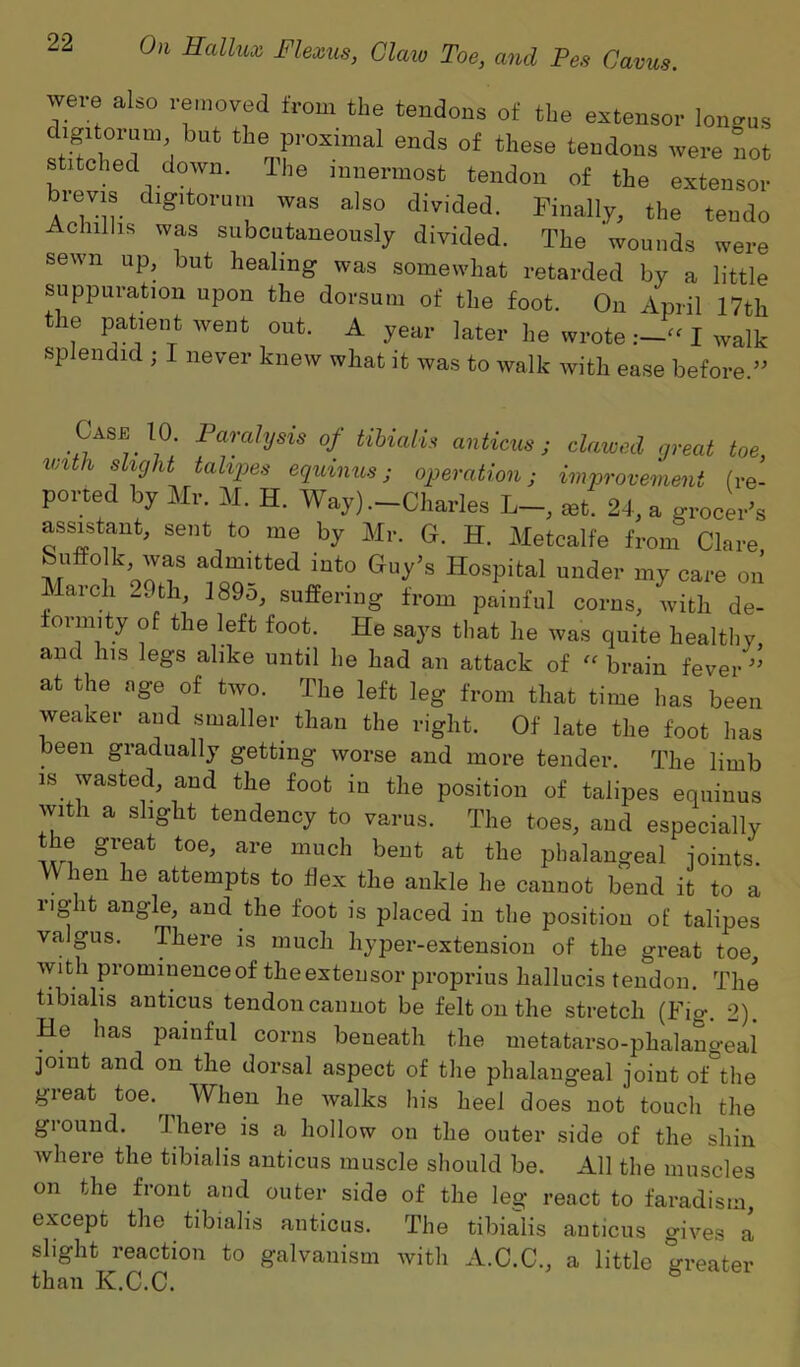 were also removed from the tendons of the extensor longus digitorum but the proximal ends of these tendons were not stitched down. The innermost tendon of the extensor brevis digitorum was also divided. Finally, the teudo Achilhs was subcutaneously divided. The wounds were sewn up, but healing was somewhat retarded by a little suppuration upon the dorsum of the foot. On April 17th the patient went out. A year later he wroteI walk splendid ; I never knew what it was to walk with ease before.” Case 10. Paralysis of tibialis anticus; clawed great toe, mtli slight talipes eqmnus; operation; improvement (re- ported by Mr. M. H. Way) .—Charles L—, set. 24, a grocer’s assistant, sent to me by Mr. G. H. Metcalfe from Clare Suffolk was admitted into Guy’s Hospital under my care on arch 2,th, 189o, suffering from painful corns, with de- formity of the left foot. He says that he was quite healthy, and Ins legs alike until he had an attack of “ brain fever” at the age of two. The left leg from that time has been weaker and smaller than the right. Of late the foot has been gradually getting worse and more tender. The limb is wasted, and the foot in the position of talipes equinus with a slight tendency to varus. The toes, and especially the great toe, are much bent at the phalangeal joints. When he attempts to hex the ankle he cannot bend it to a right angle, and the foot is placed in the position of talipes va gus. There is much hyper-extension of the great toe, with prominence of the extensor proprius hallucis tendon. The tibialis anticus tendon cannot be felt on the stretch (Fig. 2). He has painful corns beneath the metatarso-phalangeal joint and on the dorsal aspect of the phalangeal joint of°the great toe.^ When he walks his heel does not touch the giound. I here is a hollow on the outer side of the shin where the tibialis anticus muscle should be. All the muscles on the front and outer side of the leg react to faradism, except the tibialis anticus. The tibialis anticus gives a slight reaction to galvanism with A.C.C., a little greater than K.C.C. S