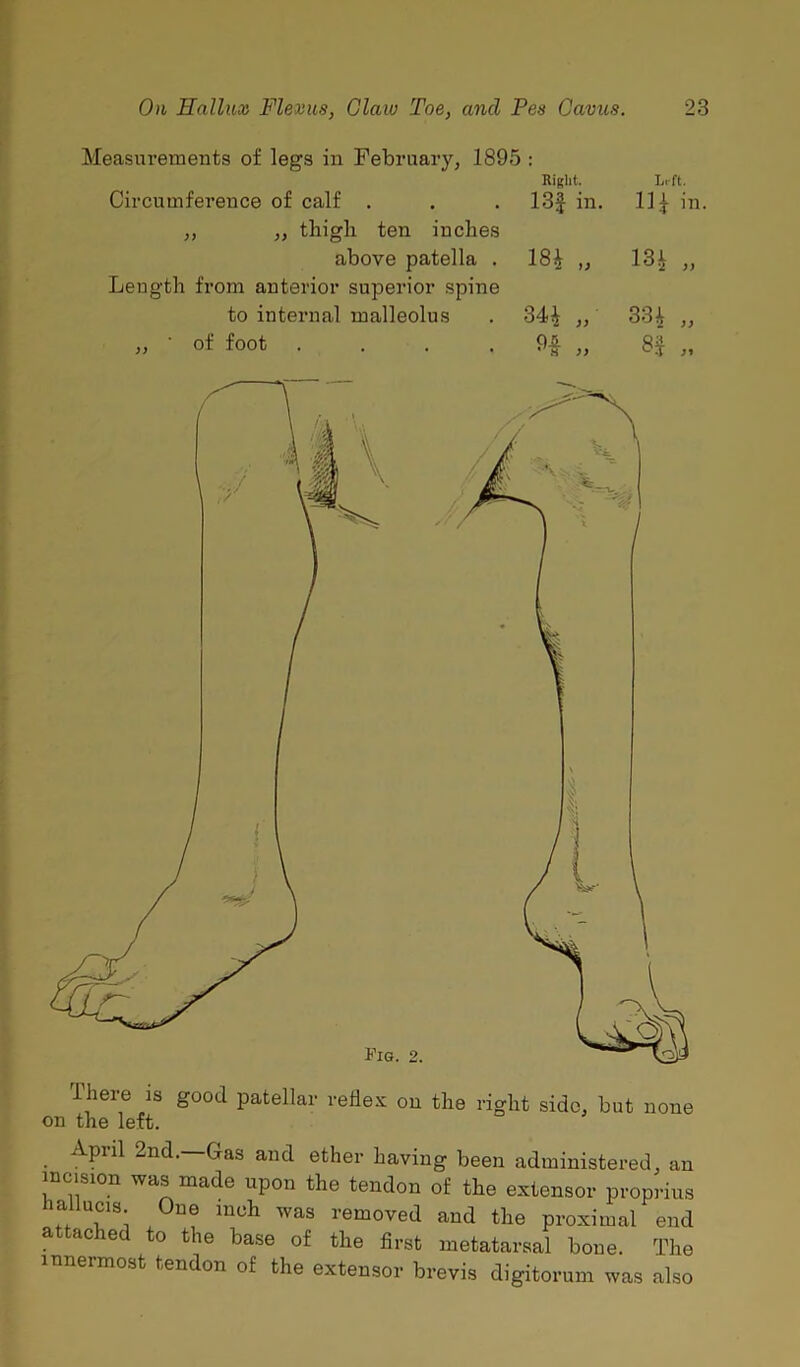 Measurements of legs in February3 1895 : Right. Left. Circumference of calf . . . 13j in. 11 £ in. ,, ,, thigh ten inches above patella . 18£ ,, 13* 33 Length from anterior superior spine to internal malleolus . 34^ ,, 334 ,, „ ■ of foot . . . 9§ „ 8$ „ Fig. 2. there is good patellar reflex on the right side, but none on the left. April 2nd.—Gas and ether having been administered, an incision was made upon the tendon of the extensor proprius hallums One inch was removed and the proximal end ached to the base of the first metatarsal bone. The innermost tendon of the extensor brevis digitorum was also