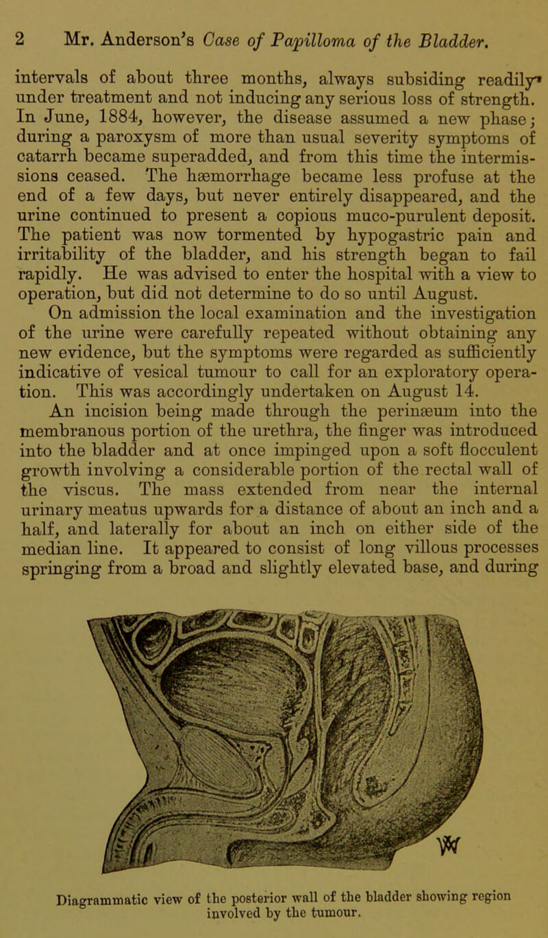 intervals of about three months, always subsiding readily* under treatment and not inducing any serious loss of strength. In June, 1884, however, the disease assumed a new phase; during a paroxysm of more than usual severity symptoms of catarrh became superadded, and from this time the intermis- sions ceased. The haemorrhage became less profuse at the end of a few days, but never entirely disappeared, and the urine continued to present a copious muco-purulent deposit. The patient was now tormented by hypogastric pain and irritability of the bladder, and his strength began to fail rapidly. He was advised to enter the hospital with a view to operation, but did not deteiunine to do so until August. On admission the local examination and the investigation of the urine were carefully repeated without obtaining any new evidence, but the symptoms were regarded as sufficiently indicative of vesical tumour to call for an exploratory opera- tion. This was accordingly undertaken on August 14. An incision being made through the perinseum into the membranous portion of the urethra, the finger was introduced into the bladder and at once impinged upon a soft flocculent growth involving a considerable portion of the rectal wall of the viscus. The mass extended from near the internal urinary meatus upwards for a distance of about an inch and a half, and laterally for about an inch on either side of the median line. It appeared to consist of long villous processes springing from a broad and slightly elevated base, and during Diagrammatic view of the posterior wall of the bladder showing region involved by the tumour.