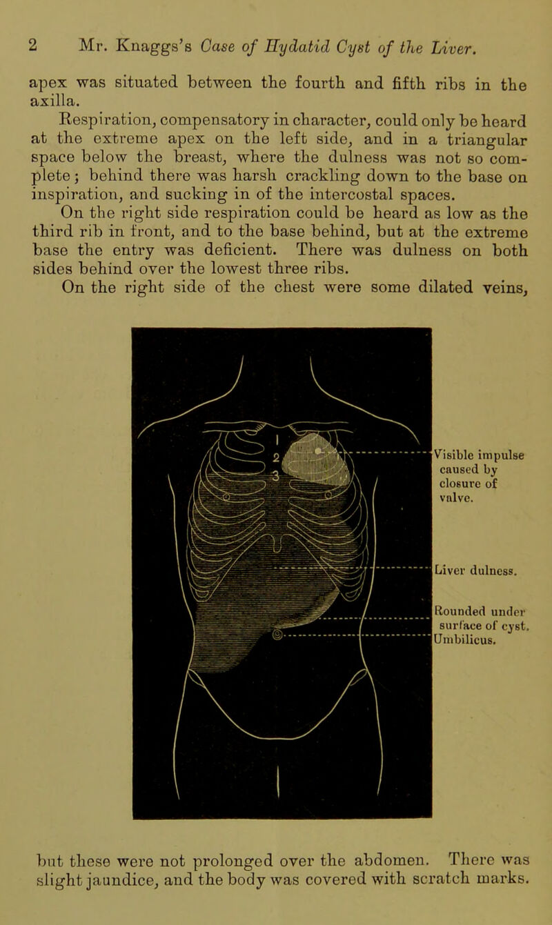 apex was situated between the fourth and fifth ribs in the axilla. Respiration, compensatory in character, could only be heard at the extreme apex on the left side, and in a triangular space below the breast, where the dulness was not so com- plete; behind there was harsh crackling down to the base on inspiration, and sucking in of the intercostal spaces. On the right side respiration could be heard as low as the third rib in front, and to the base behind, but at the extreme base the entry was deficient. There was dulness on both sides behind over the lowest three ribs. On the right side of the chest were some dilated veins. Visible impulse caused by closure of valve. Liver dulness. Rounded under surface of cyst. Umbilicus. but these were not prolonged over the abdomen. There was slight jaundice, and the body was covered with scratch marks.