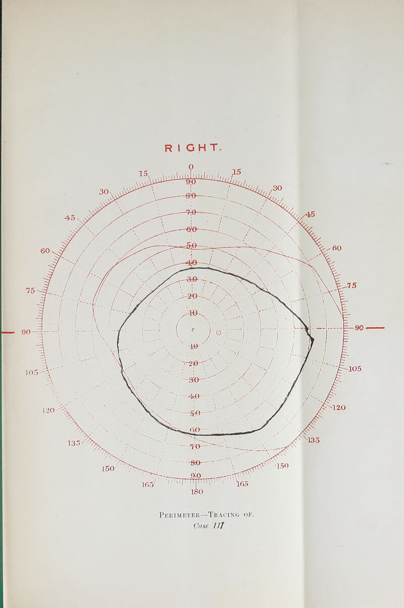 RIGHT. eter—Tracing of. Case I IT