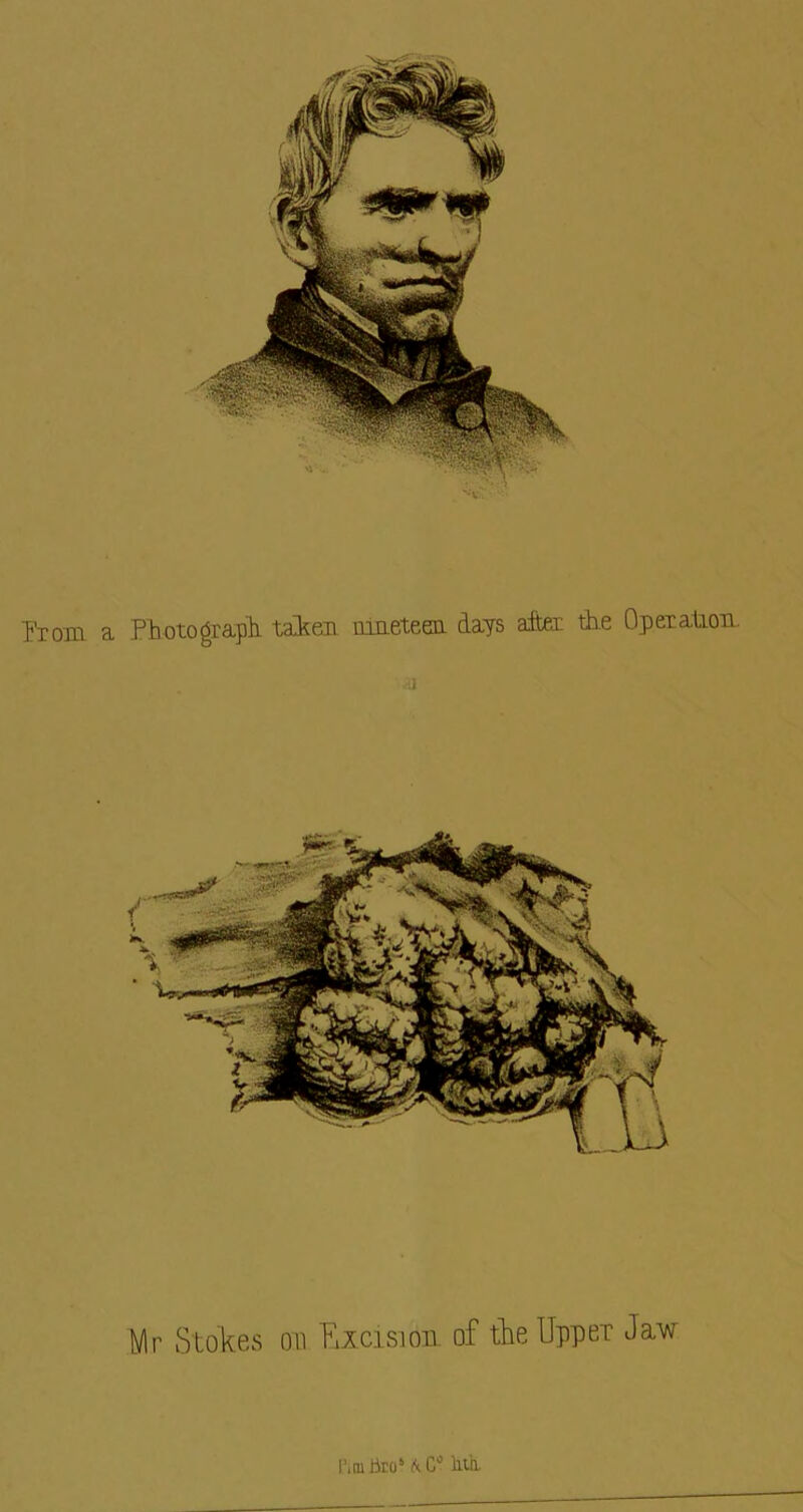 Prom a Photograph, taker imeteer days alter the Operalior. a Mr Stokes on Rxcisiou of the Upper Jaw Itrn iiros A. C° Ml