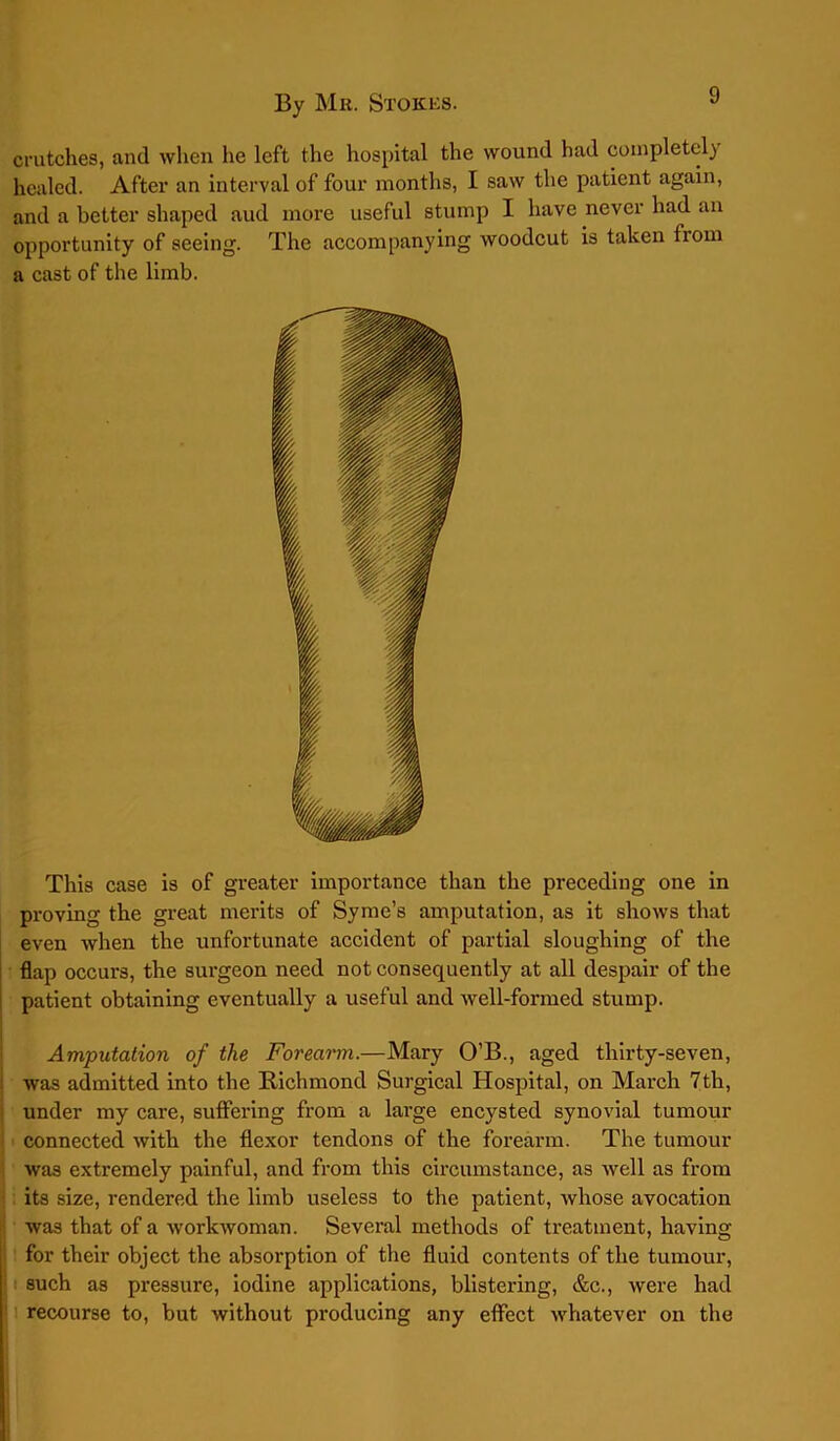 crutches, and when he left the hospital the wound had completely healed. After an interval of four months, I saw the patient again, and a better shaped aud more useful stump I have never had an opportunity of seeing. The accompanying woodcut is taken from a cast of the limb. This case is of greater importance than the preceding one in proving the great merits of Syme’s amputation, as it shows that even when the unfortunate accident of partial sloughing of the flap occurs, the surgeon need not consequently at all despair of the patient obtaining eventually a useful and well-formed stump. Amputation of the Forearm.—Mary O’B., aged thirty-seven, was admitted into the Richmond Surgical Hospital, on March 7th, under my care, suffering from a large encysted synovial tumour connected with the flexor tendons of the forearm. The tumour was extremely painful, and from this circumstance, as well as from its size, rendered the limb useless to the patient, whose avocation was that of a workwoman. Several methods of treatment, having for their object the absorption of the fluid contents of the tumour, such as pressure, iodine applications, blistering, &c., were had recourse to, but without producing any effect whatever on the