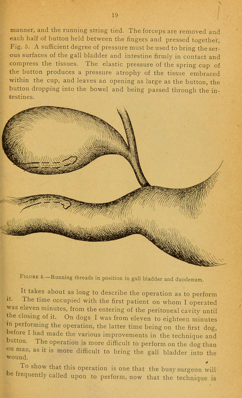 manner, and the running string tied. The forceps are removed and each half of button held between the fingers and pressed together, Fig. 5. A sufficient degree of pressure must be used to bring the ser- ous surfaces of the gall bladder and intestine firmly in contact and compress the tissues. The elastic pressure of the spring cup of the button produces a pressure atrophy of the tissue embraced within the cup, and leaves an opening as large as the button, the button dropping into the bowel and being passed through the in- testines. Figure 4.—Running threads in position in gall bladder and duodenum. It takes about as long to describe the operation as to perform it. The time occupied with the first patient on whom I operated was eleven minutes, from the entering of the peritoneal cavity until the closing of it. On dogs I was from eleven to eighteen minutes in performing the operation, the latter time being on the first dog, efore I had made the various improvements in the technique and utton. The operation is more difficult to perform on the dog than on man, as it is more difficult to bring the gall bladder into the wound. To show that this operation is one that the busy surgeon will e requently called upon to perform, now that the technique is