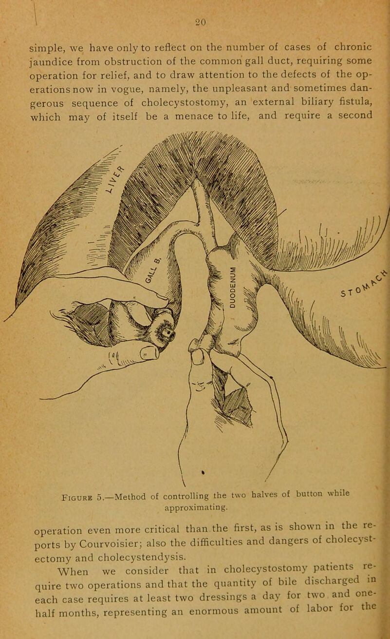 simple, we have only to reflect on the number of cases of chronic jaundice from obstruction of the common gall duct, requiring some operation for relief, and to draw attention to the defects of the op- erations now in vogue, namely, the unpleasant and sometimes dan- gerous sequence of cholecystostomy, an external biliary fistula, which may of itself be a menace to life, and require a second Figure 5.—Method o£ controlling the two halves of button while approximating. operation even more critical than the first, as is shown in the re- ports by Courvoisier; also the difficulties and dangers of cholecyst- ectomy and cholecystendysis. When we consider that in cholecj'stostomy patients re- quire two operations and that the quantity of bile discharged in each case requires at least two dressings a day for two and one- half months, representing an enormous amount of labor for t le