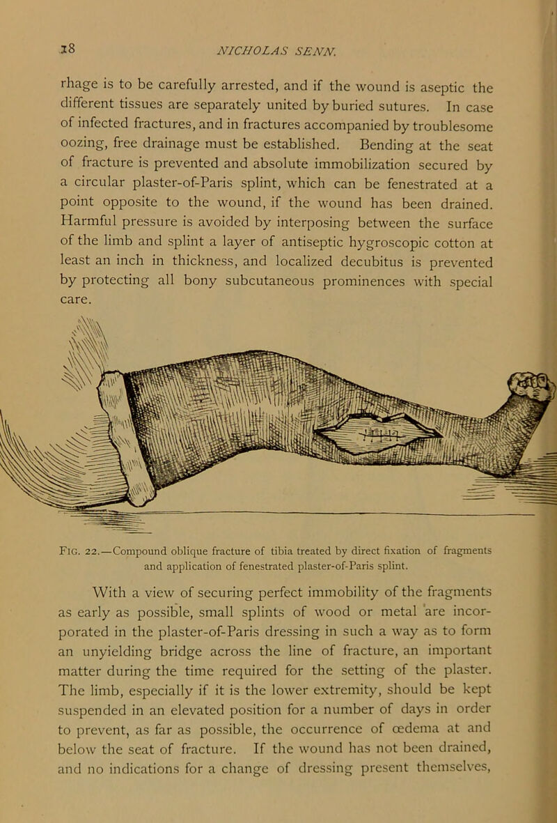 rhage is to be carefully arrested, and if the wound is aseptic the different tissues are separately united by buried sutures. In case of infected fractures, and in fractures accompanied by troublesome oozing, free drainage must be established. Bending at the seat of fracture is prevented and absolute immobilization secured by a circular plaster-of-Paris splint, which can be fenestrated at a point opposite to the wound, if the wound has been drained. Harmful pressure is avoided by interposing between the surface of the limb and splint a layer of antiseptic hygroscopic cotton at least an inch in thickness, and localized decubitus is prevented by protecting all bony subcutaneous prominences with special care. Fig. 22.—Compound oblique fracture of tibia treated by direct fixadon of fragments and application of fenestrated plaster-of-Paris splint. With a view of securing perfect immobility of the fragments as early as possible, small splints of wood or metal are incor- porated in the plaster-of-Paris dressing in such a way as to form an unyielding bridge across the line of fracture, an important matter during the time required for the setting of the plaster. The limb, especially if it is the lower extremity, should be kept suspended in an elevated position for a number of days in order to prevent, as far as possible, the occurrence of oedema at and below the seat of fracture. If the wound has not been drained, and no indications for a change of dressing present themselves,