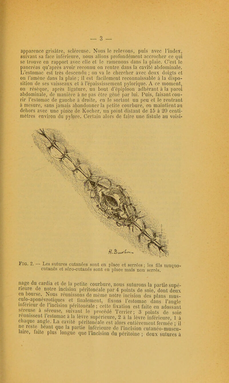 apparence grisâtre, scléreuse. Nous le relevons, puis avec l’index, suivant sa l'ace inréi'ieure, nous allons profonclcinent accrocher ce qui se trouve en rapport avec elle et le ramenons dans la plaie. C’est le pancréas qu’après avoir reconnu on rentre dans la cavité abdominale. L’estomac est très descendu ; on va le chercher avec deux doigts et on l’amène dans la plaie ; il est facilement reconnaissable à la dispo- sition de ses vaisseaux et à l’épaississement pylorique. A ce moment, on résèque, après ligature, un bout d’épiploon adhérant à la paroi abdominale, de manière à ne pas être gêné par lui. Puis, faisant cou- rir l’estomac de gauche à droite, en le sortant un peu et le rentrant à mesure, sans jamais abandonner la petite courbure, on maintient au dehors avec une pince de Kocher, un point distant de 15 à 20 centi- mètres environ du pylore. Certain alors de faire une fistule au voisi- Fig. 2. Les sutures cutanées sont en place et serrées ; les fils niuquo- cutanes et séro-cutanés sont en place mais non serrés. nage du cardia et de la petite courbure, nous suturons la partie supé- rieure de notre incision péritonéale par 4 points de soie, dont deux en bourse. Nous réunissons de même notre incision des plans mus- culo-aponévrotiques et linalement, fixons l’estomac dans l’angle intérieur de I incision péritonéale; cette fixation est faite en adossant sereuse a séreuse, suivant le procédé Terrier; 3 points de soie reunissent 1 estomac à la lèvre supérieure, 2 à la lèvre inférieure, 1 à chaque angle. La cavité péritonéale est alors entièrement fermée ; il ne reste béant que la partie inférieure de fincision cutanéo-muscii- laire, laite plus longue ([uc l’incision du péritoine ; deux sutures à