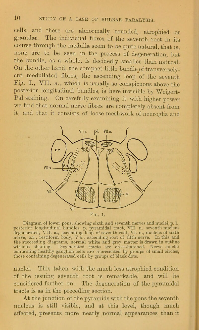 cells, and these are abnormally rounded, atrophied or granular. The individual fibres of the seventh root in its course through the medulla seem to be quite natural, that is, none are to be seen in the process of degeneration, but the bundle, as a whole, is decidedly smaller than natural. On the other hand, the compact little bundleoftransversely- cut medullated fibres, the ascending loop of the seventh Fig. I., VII. a., which is usually so conspicuous above the posterior longitudinal bundles, is here invisible by Weigert- Pal staining. On carefully examining it with higher power we find that normal nerve fibres are completely absent from it, and that it consists of loose meshwork of neuroglia and Diagram of lower pons, showing sixth and seventh nerves and nuclei, p. 1., posterior longitudinal bundles, p. pyramidal tract, VII. n., seventh nucleus degenerated, VII. a., ascending loop of seventh root, VI. n., nucleus of sixth nerve, c.r., restiform body, V.a., asceuding root of fifth nerve. In this and the succeeding diagrams, normal white and grey matter is drawn in outline without shading. Degenerated tracts are cross-hatched. Nerve -nuclei containing healthy ganglion cells are represented by groups of small circles, those containing degenerated cells by groups of black dots. nuclei. This taken with the much less atrophied condition of the issuing seventh root is remarkable, and will be considered further on. The degeneration of the pyramidal tracts is as in the preceding section. At the junction of the pyramids with the pons the seventh nucleus is still visible, and at this level, though much affected, presents more nearly normal appearances than it