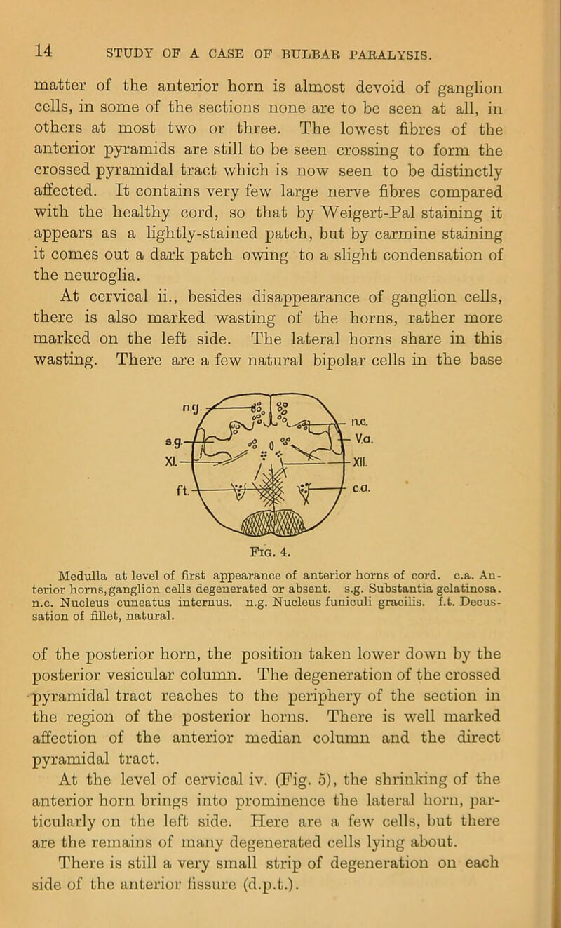 matter of the anterior horn is almost devoid of ganglion cells, in some of the sections none are to be seen at all, in others at most two or three. The lowest fibres of the anterior pyramids are still to be seen crossing to form the crossed pyramidal tract which is now seen to be distinctly affected. It contains very few large nerve fibres compared with the healthy cord, so that by Weigert-Pal staining it appears as a lightly-stained patch, but by carmine staining it comes out a dark patch owing to a slight condensation of the neuroglia. At cervical ii., besides disappearance of ganglion cells, there is also marked wasting of the horns, rather more marked on the left side. The lateral horns share in this wasting. There are a few natural bipolar cells in the base Medulla at level of first appearance of anterior horns of cord. c.a. An- terior horns, ganglion cells degenerated or absent, s.g. Substantia gelatinosa. n.c. Nucleus cuneatus internus. n.g. Nucleus funiculi gracilis, f.t. Decus- sation of fillet, natural. of the posterior horn, the position taken lower down by the posterior vesicular column. The degeneration of the crossed pyramidal tract reaches to the periphery of the section in the region of the posterior horns. There is well marked affection of the anterior median column and the direct pyramidal tract. At the level of cervical iv. (Fig. 5), the shrinking of the anterior horn brings into prominence the lateral horn, par- ticularly on the left side. Here are a few cells, but there are the remains of many degenerated cells lying about. There is still a very small strip of degeneration on each side of the anterior fissure (d.p.t.).