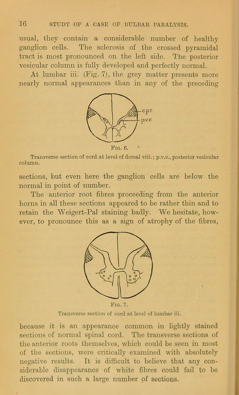 usual, they contain a considerable number of healthy ganglion cells. The sclerosis of the crossed pyramidal tract is most pronounced on the left side. The posterior vesicular column is fully developed and perfectly normal. At lumbar iii. (Fig. 7), the grey matter presents more nearly normal appearances than in any of the preceding Transverse section of cord at level of dorsal viii.; p.v.c., posterior vesicular column. sections, but even here the ganglion cells are below the normal in point of number. The anterior root fibres proceeding from the anterior horns in all these sections appeared to be rather thin and to retain the Weigert-Pal staining badly. We hesitate, how- ever, to pronounce this as a sign of atrophy of the fibres, Transverse section of cord at level of lumbar iii. because it is an appearance common in lightly stained sections of normal spinal cord. The transverse sections of the anterior roots themselves, which could be seen in most of the sections, were critically examined with absolutely negative results. It is difficult to believe that any con- siderable disappearance of white fibres could fail to be discovered in such a large number of sections.