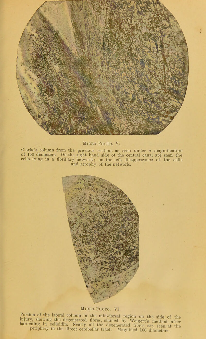 Clarke’s column from the previous section, as seen under a magnification of 160 diameters. On the right hand side of the central canal are seen the cells lying in a fibrillary network; on the left, disappearance of the cells and atrophy of the network. Miceo-Photo. VI. Portion of the lateral column in the mid-dorsal region on the side of the injury, showing the degenerated fibres, stained by VVeigerfs method after hardening in celloidiii. Nearly all the degenerated fibres are seen at the periphery in the direct cerebellar tract. Magnified 100 diameters.